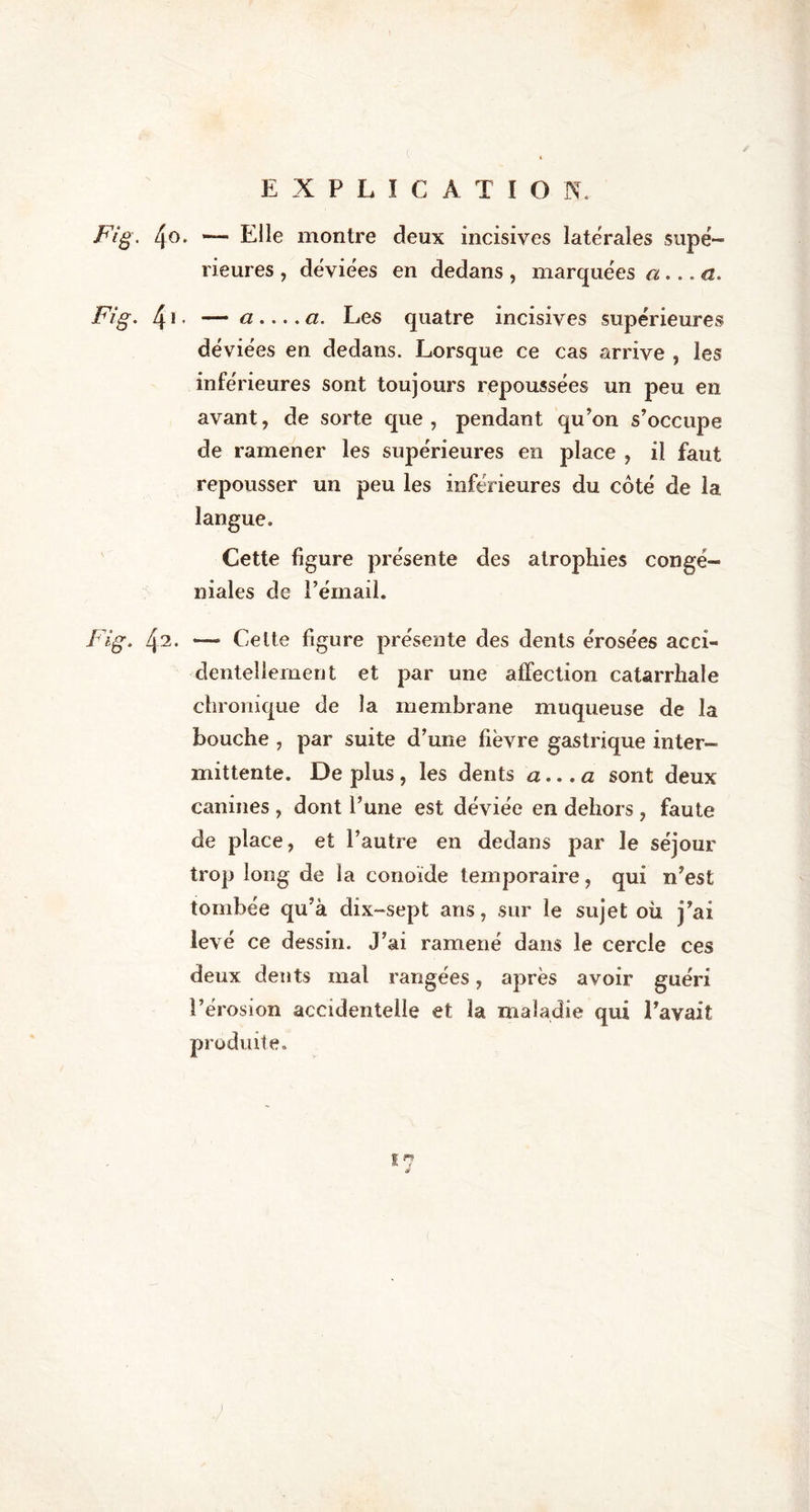 Fig. 4o. *— Elle montre deux incisives latérales supé- rieures , déviées en dedans , marquées a... a. Fig. 41 - — « • • • « Cl • Les quatre incisives supérieures déviées en dedans. Lorsque ce cas arrive , les inférieures sont toujours repoussées un peu en avant, de sorte que, pendant qu’on s’occupe de ramener les supérieures en place , il faut repousser un peu les inférieures du côté de la langue. Cette figure présente des atrophies congé- niales de l’émail. Fig. 42. •—* Celte figure présente des dents érosées acci- dentellement et par une affection catarrhale chronique de la membrane muqueuse de la bouche , par suite d’une fièvre gastrique inter- mittente. De plus, les dents a., .a sont deux canines , dont l’une est déviée en dehors, faute de place, et l’autre en dedans par le séjour trop long de la conoïde temporaire, qui n’est tombée qu’à dix-sept ans, sur le sujet où j’ai levé ce dessin. J’ai ramené dans le cercle ces deux dents mal rangées, après avoir guéri l’érosion accidentelle et la maladie qui l’avait produite. ir