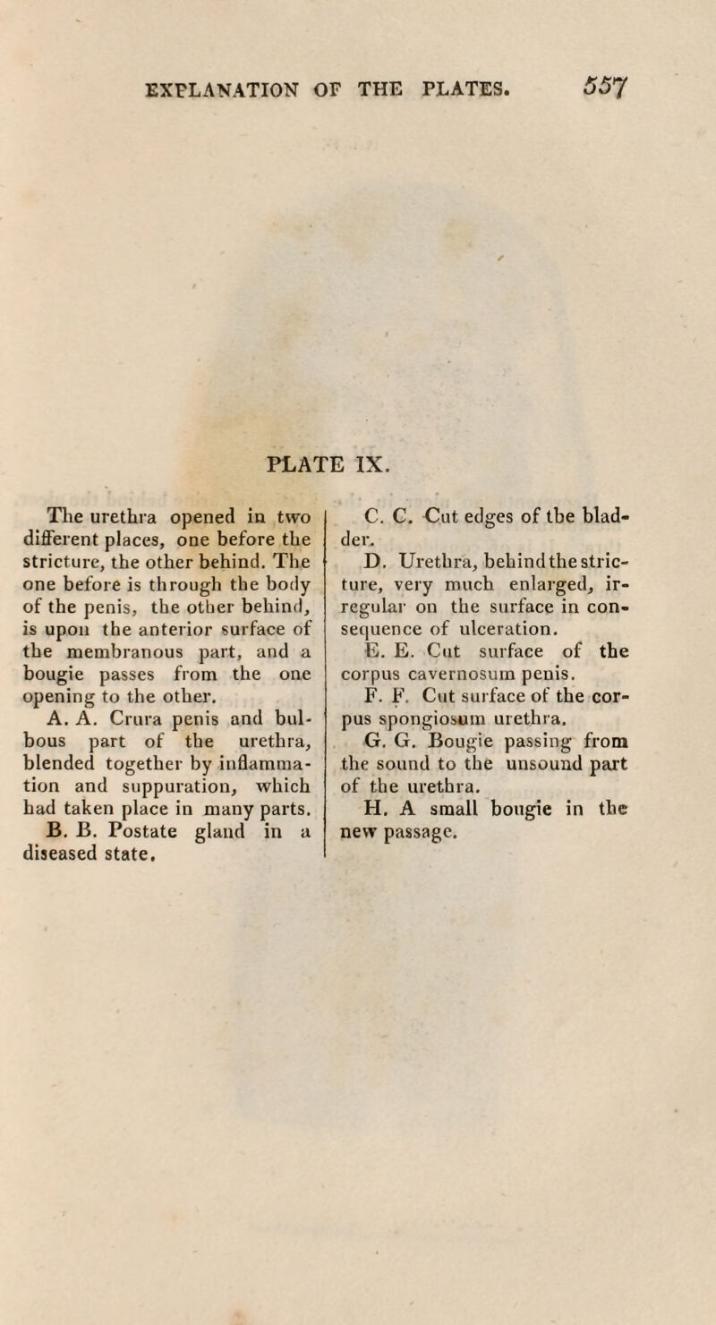 PLATE IX. The urethra opened in two different places, one before the stricture, the other behind. The one before is through the body of the penis, the other behind, is upon the anterior surface of the membranous part, and a bougie passes from the one opening to the other. A. A. Crura penis and bul¬ bous part of the urethra, blended together by inflamma¬ tion and suppuration, which had taken place in many parts. B. B. Postate gland in a diseased state. C. C. Cut edges of tbe blad¬ der. D. Urethra, behind the stric¬ ture, very much enlarged, ir¬ regular on the surface in con¬ sequence of ulceration. E. E. Cut surface of the corpus cavernosum penis. F. F. Cut surface of the cor¬ pus spongiosum urethra. G. G. Bougie passing from the sound to the unsound part of the urethra. H. A small bougie in the new passage.
