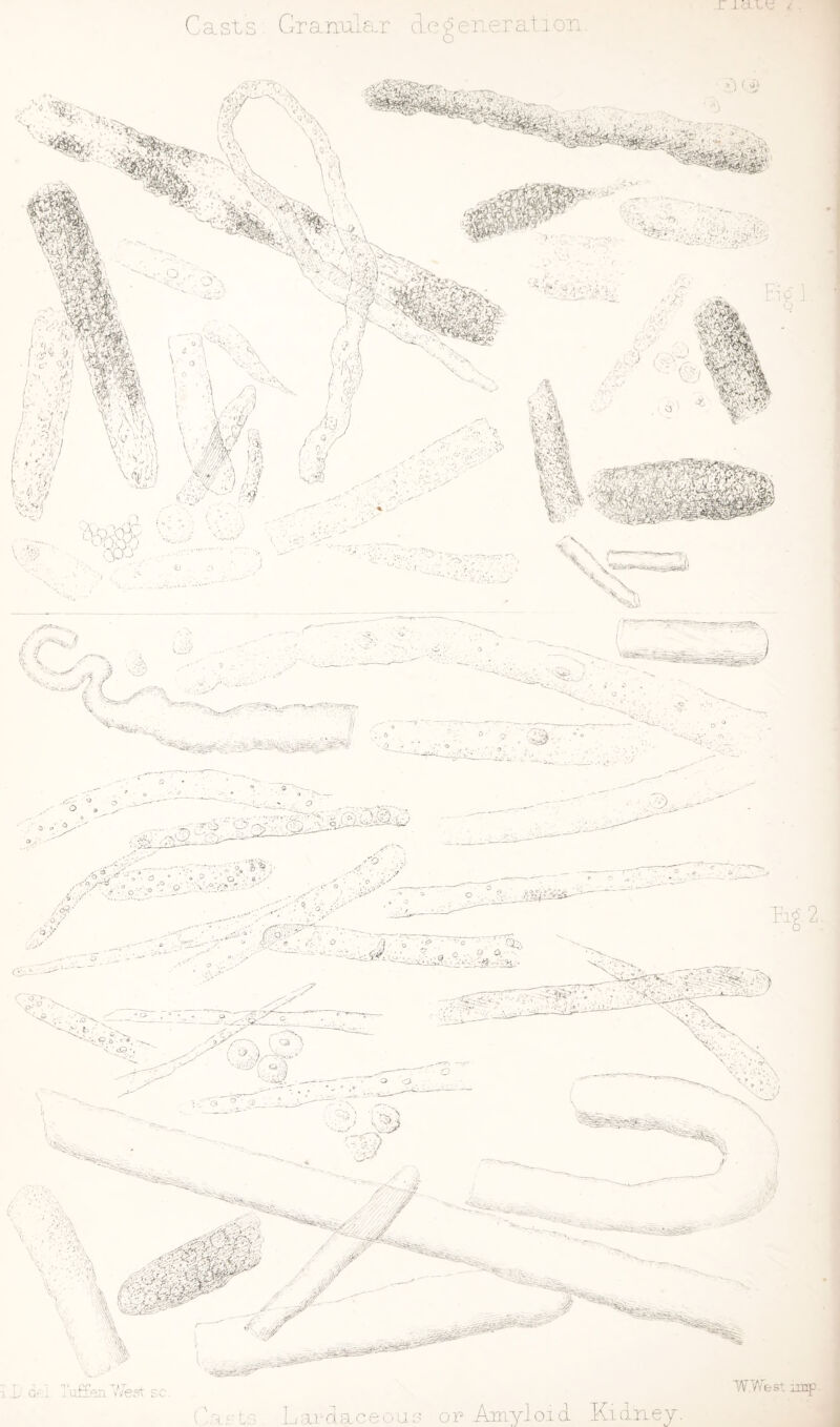 Casts Granular degeneration.