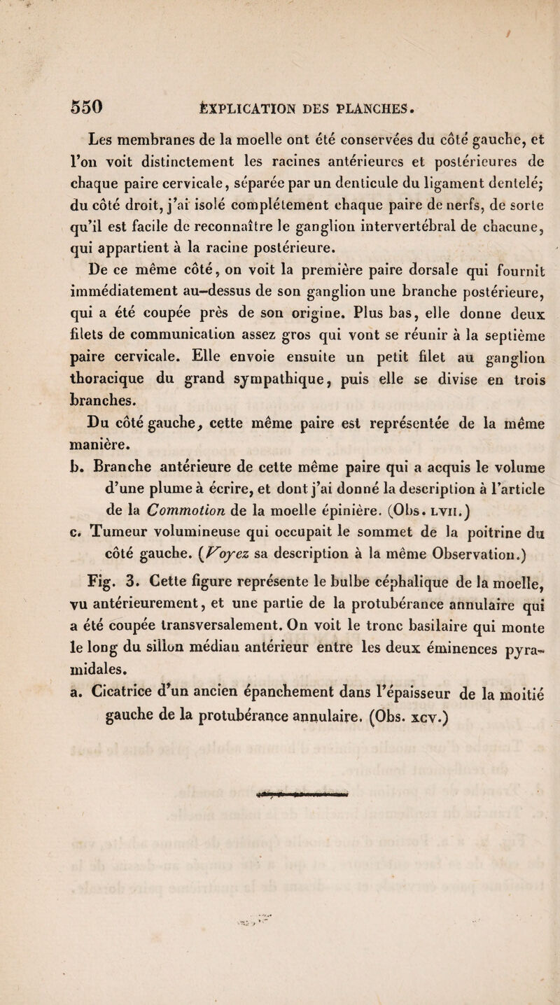 Les membranes de la moelle ont été conservées du côté gauche, et l’on voit distinctement les racines antérieures et postérieures de chaque paire cervicale, séparée par un denticule du ligament dentelé; du côté droit, j’ai isolé complètement chaque paire de nerfs, de sorte qu’il est facile de reconnaître le ganglion intervertébral de chacune, qui appartient à la racine postérieure. De ce même côté, on voit la première paire dorsale qui fournit immédiatement au-dessus de son ganglion une branche postérieure, qui a été coupée près de son origine. Plus bas, elle donne deux filets de communication assez gros qui vont se réunir à la septième paire cervicale. Elle envoie ensuite un petit filet au ganglion thoracique du grand sympathique, puis elle se divise en trois branches. Du côté gauche, cette même paire est représentée de la même manière. b. Branche antérieure de cette même paire qui a acquis le volume d’une plume à écrire, et dont j’ai donné la description à l’article de la Commotion de la moelle épinière. (Obs. lvii.) c. Tumeur volumineuse qui occupait le sommet de la poitrine du côté gauche. (Voyez sa description à la même Observation.) Fig. 3. Cette figure représente le bulbe céphalique de la moelle, vu antérieurement, et une partie de la protubérance annulaire qui a été coupée transversalement. On voit le tronc basilaire qui monte le long du sillon médian antérieur entre les deux éminences pyra¬ midales. a. Cicatrice d’un ancien épanchement dans l’épaisseur de la moitié gauche de la protubérance annulaire. (Obs. xcv.)