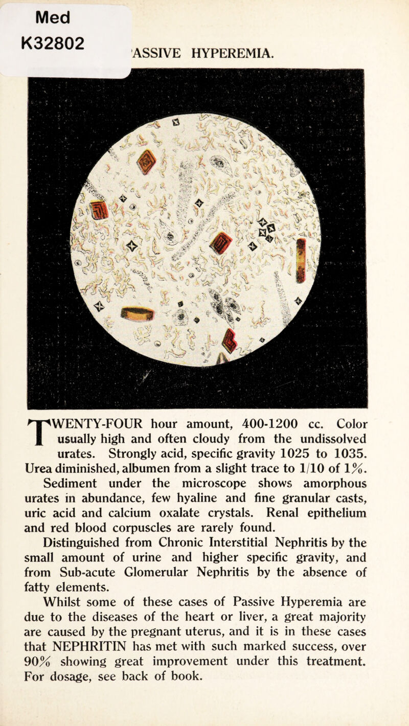 Med K32802 ASSIVE HYPEREMIA. TWENTY-FOUR hour amount, 400-1200 cc. Color usually high and often cloudy from the undissolved urates. Strongly acid, specific gravity 1025 to 1035. Urea diminished, albumen from a slight trace to 1/10 of 1%. Sediment under the microscope shows amorphous urates in abundance, few hyaline and fine granular casts, uric acid and calcium oxalate crystals. Renal epithelium and red blood corpuscles are rarely found. Distinguished from Chronic Interstitial Nephritis by the small amount of urine and higher specific gravity, and from Sub-acute Glomerular Nephritis by the absence of fatty elements. Whilst some of these cases of Passive Hyperemia are due to the diseases of the heart or liver, a great majority are caused by the pregnant uterus, and it is in these cases that NEPHRITIN has met with such marked success, over 90% showing great improvement under this treatment. For dosage, see back of book.