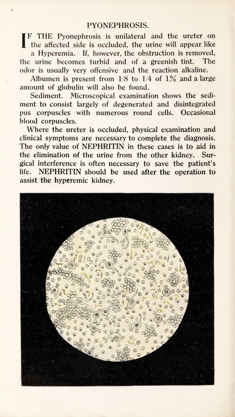 PYONEPHROSIS. IF THE Pyonephrosis is unilateral and the ureter on the affected side is occluded, the urine will appear like a Hyperemia. If, however, the obstruction is removed, the urine becomes turbid and of a greenish tint. The odor is usually very offensive and the reaction alkaline. Albumen is present from 1/8 to 1/4 of 1% and a large amount of globulin will also be found. Sediment. Microscopical examination shows the sedi¬ ment to consist largely of degenerated and disintegrated pus corpuscles with numerous round cells. Occasional blood corpuscles. Where the ureter is occluded, physical examination and clinical symptoms are necessary to complete the diagnosis. The only value of NEPHRITIN in these cases is to aid in the elimination of the urine from the other kidney. Sur¬ gical interference is often necessary to save the patient's life. NEPHRITIN should be used after the operation to assist the hyperemic kidney.