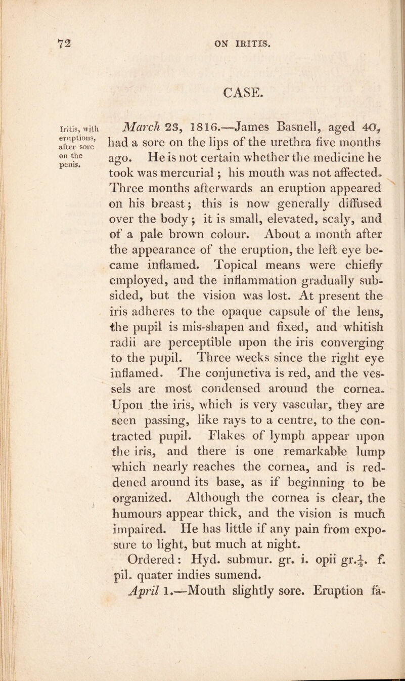 Iritis, with eruptions, after sore on the penis. CASE. J March 23, 1816.—James Basnell, aged 40* had a sore on the lips of the urethra five months ago. He is not certain whether the medicine he took was mercurial; his mouth was not affected. Three months afterwards an eruption appeared on his breast; this is now generally diffused over the body ; it is small, elevated, scaly, and of a pale brown colour. About a month after the appearance of the eruption, the left eye be- came inflamed. Topical means were chiefly employed, and the inflammation gradually sub- sided, but the vision was lost. At present the iris adheres to the opaque capsule of the lens, the pupil is mis-shapen and fixed, and whitish radii are perceptible upon the iris converging to the pupil. Three weeks since the right eye inflamed. The conjunctiva is red, and the ves- sels are most condensed around the cornea. Upon the iris, which is very vascular, they are seen passing, like rays to a centre, to the con- tracted pupil. Flakes of lymph appear upon the iris, and there is one remarkable lump which nearly reaches the cornea, and is red- dened around its base, as if beginning to be organized. Although the cornea is clear, the humours appear thick, and the vision is much impaired. He has little if any pain from expo- sure to light, but much at night. Ordered: Hyd. submur. gr. i. opii gr.J. fe pih quater indies sumend. April 1.—Mouth slightly sore. Eruption fa-