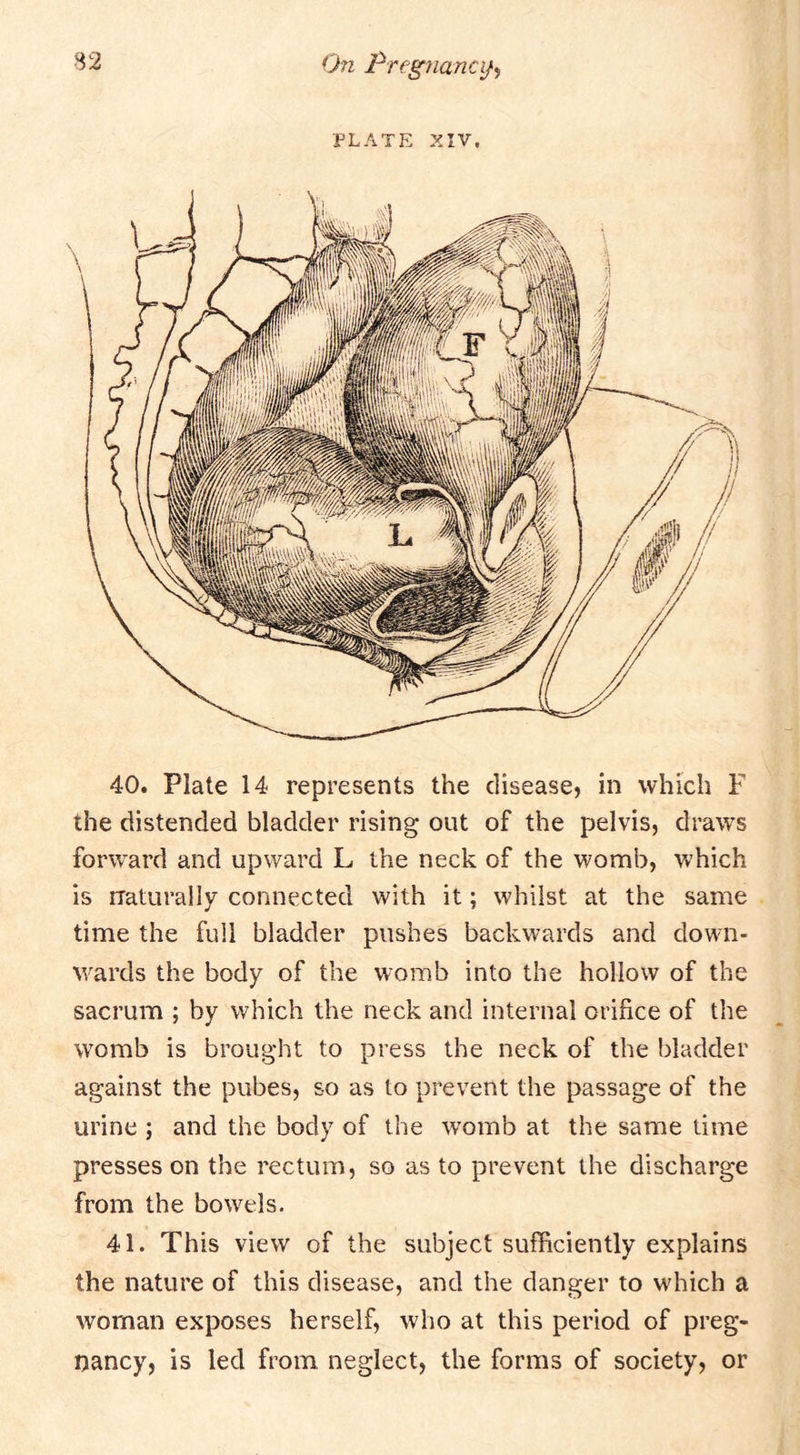 PLATE XIV, 40. Plate 14 represents the disease, in which F the distended bladder rising* out of the pelvis, draws forward and upward L the neck of the womb, which is rraturally connected with it; whilst at the same time the full bladder pushes backwards and down- wards the body of the womb into the hollow of the sacrum ; by which the neck and internal orifice of the womb is brought to press the neck of the bladder against the pubes, so as to prevent the passage of the urine ; and the body of the womb at the same time presses on the rectum, so as to prevent the discharge from the bowels. 41. This view of the subject sufficiently explains the nature of this disease, and the danger to which a woman exposes herself, who at this period of preg- nancy, is led from neglect, the forms of society, or