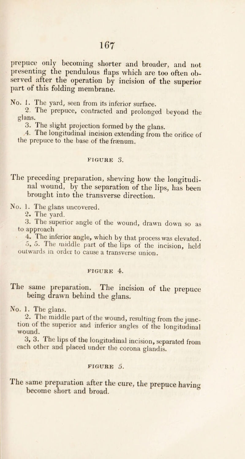 prepuce only becoming shorter and broader, and not presenting the pendulous Haps which are too often ob- served after the operation by incision of the superior part of this folding membrane. No. i. The yard, seen from its inferior surface. 2. The prepuce, contracted and prolonged beyond the glans. 3. The slight projection formed by the glans. 4. The longitudinal incision extending from the orifice of the prepuce to the base of the fraenum. figure 3. The preceding preparation, shelving how the longitudi- nal wound, by the separation of the lips, has been brought into the transverse direction. No. 1. The glans uncovered. 2. The yard. 3. The superior angle ot the wound, drawn down so as to approach 4. 4 he inferior angle, which by that process was elevated. 5. 5. The middle part of the lips of the incision, held outwards in order to cause a transverse union. FIGURE 4. The same preparation. The incision of the prepuce being drawn behind the glans. No. 1. The glans. 2. The middle part ot the wound, resulting from the junc- tion of the superior and inferior angles of the longitudinal wound. 3, 3. The lips ot the longitudinal incision, separated from each other and placed under the corona glandis. FIGURE 5. The same preparation after the cure, the prepuce having become short and broad.