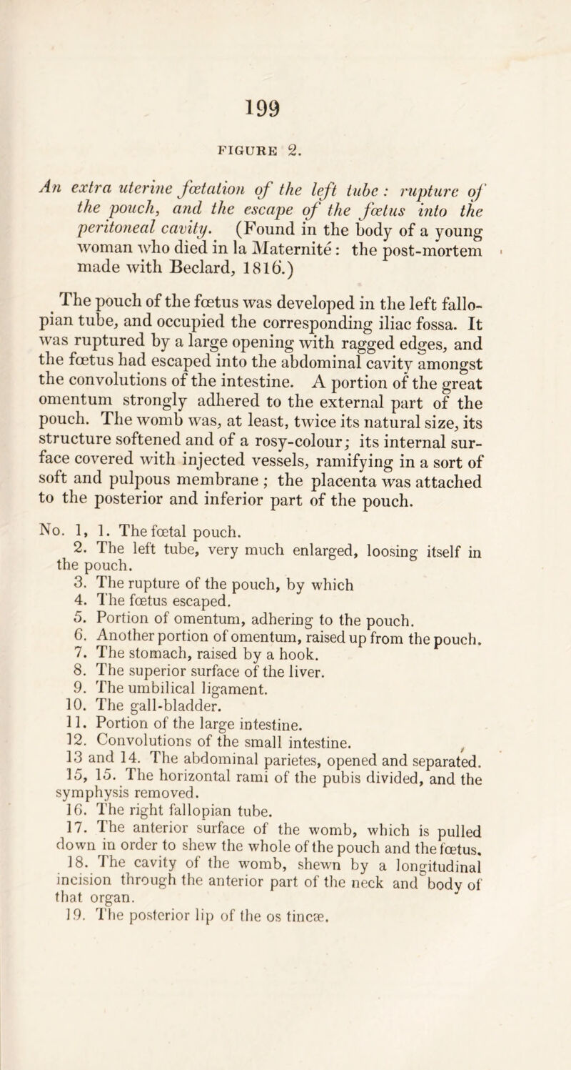 FIGURE 2. An extra uterine fcetaiion of the left tube: rupture of the pouch, and the escape of the foetus into the peritoneal cavity. (Found in the body of a young woman who died in la Maternite: the post-mortem made with Beclard, 1816‘.) The pouch of the foetus was developed in the left fallo- pian tube, and occupied the corresponding iliac fossa. It was ruptured by a large opening with ragged edges, and the foetus had escaped into the abdominal cavity amongst the convolutions of the intestine. A portion of the great omentum strongly adhered to the external part of the pouch. The womb was, at least, twice its natural size, its structure softened and of a rosy-colour; its internal sur- face covered with injected vessels, ramifying in a sort of soft and pulpous membrane ; the placenta was attached to the posterior and inferior part of the pouch. No. 1, 1. The foetal pouch. 2. The left tube, very much enlarged, loosing itself in the pouch. 3. The rupture of the pouch, by which 4. The foetus escaped. 5. Portion of omentum, adhering to the pouch. 6. Another portion of omentum, raised up from the pouch. 7. The stomach, raised by a hook. 8. The superior surface of the liver. 9. The umbilical ligament. 10. The gall-bladder. 11. Portion of the large intestine. 12. Convolutions of the small intestine. 13 and 14. The abdominal parietes, opened and separated. 15. 15. The horizontal rami of the pubis divided, and the symphysis removed. 16. The right fallopian tube. 17. The anterior surface of the womb, which is pulled down in order to shew the whole of the pouch and the fcetus, 18. The cavity of the womb, shewn by a longitudinal incision through the anterior part of the neck and body of that organ. 19. The posterior lip of the os tincse.