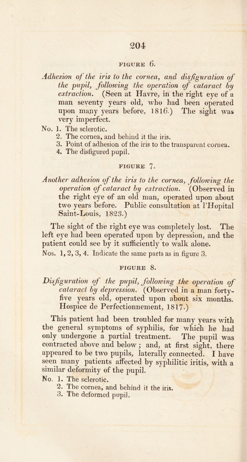 FIGURE 6. Adhesion of the iris to the cornea, and disfiguration of the 'pupil, following the operation of cataract by extraction. (Seen at Havre, in the right eye of a man seventy years old, who had been operated upon many years before, 18lb.) The sight was very imperfect. No. 1. The sclerotic. 2. The cornea, and behind it the iris. 3. Point of adhesion of the iris to the transparent cornea. 4. The disfigured pupil. FIGURE 7- Another adhesion of the iris to the cornea, following the operation of cataract by extraction. (Observed in the right eye of an old man, operated upon about two years before. Public consultation at l’Hopital Saint-Louis, 1823.) The sight of the right eye was completely lost. The left eye had been operated upon by depression, and the patient could see by it sufficiently to walk alone. Nos. 1, 2, 3, 4. Indicate the same parts as in figure 3. FIGURE 8. 'Disfiguration of the pupil, following the operation of cataract by depression. (Observed in a man forty- five years old, operated upon about six months. Hospice de Perfectionnement, 1817-) This patient had been troubled for many years with the general symptoms of syphilis, for which he had only undergone a partial treatment. The pupil was contracted above and below; and, at first sight, there appeared to be two pupils, laterally connected. I have seen many patients affected by syphilitic iritis, with a similar deformity of the pupil. No. 1. The sclerotic. 2. The cornea, and behind it the iris. 3. The deformed pupil.