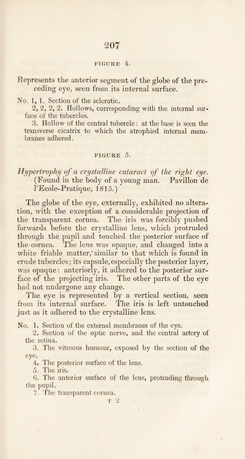 207 FIGURE 4. Represents the anterior segment of the globe of the pre- ceding eye, seen from its internal surface. No. 1,1. Section of the sclerotic. 2, 2, 2, 2. Hollows, corresponding with the internal sur- face of the tubercles. 3. Hollow of the central tubercle: at the base is seen the transverse cicatrix to which the atrophied internal mem- branes adhered. FIGURE 5. Hypertrophy of a crystalline cataract of the right eye. (Found in the body of a young man. Pavilion de l’Ecole-Pratique, 1815.) The globe of the eye, externally, exhibited no altera- tion, with the exception of a considerable projection of the transparent cornea. The iris was forcibly pushed forwards before the crystalline lens, which protruded through the pupil and touched the posterior surface of the cornea. The lens was opaque, and changed into a white friable matter,'similar to that which is found in crude tubercles; its capsule, especially the posterior layer, was opaque: anteriorly, it adhered to the posterior sur- face of the projecting iris. The other parts of the eye had not undergone any change. The eye is represented by a vertical section, seen from its internal surface. The iris is left untouched just as it adhered to the crystalline lens. No. 1. Section of the external membranes of the eye. 2. Section of the optic nerve, and the central artery of the retina. 3. The vitreous humour, exposed by the section of the eye. 4. The posterior surface of the lens. 5. The iris. 0. The anterior surface of the lens, protruding through the pupil.