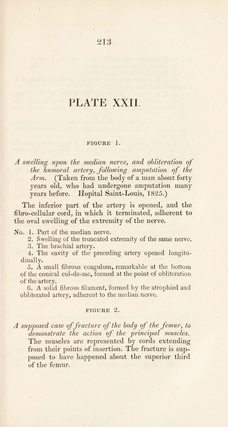 PLATE XXII. FIGURE 1. A swelling upon the median nerve, and obliteration of the humoral artery, following amputation of the Arm. (Taken from the body of a man about forty years old, who had undergone amputation many years before. Hopital Saint-Louis, 1825.) The inferior part of the artery is opened, and the fibro-cellular cord, in which it terminated, adherent to the oval swelling of the extremity of the nerve. No. 1. Part of the median nerve. 2. Swelling of the truncated extremity of the same nerve. 3. The brachial artery. 4. The cavity of the preceding artery opened longitu- dinally. 5. A small fibrous coagulum, remarkable at the bottom of the conical cul-de-sac, formed at the point of obliteration of the artery. 6. A solid fibrous filament, formed by the atrophied and obliterated artery, adherent to the median nerve. FIGURE 2. A supposed case of fracture of the body of the femur, to demonstrate the action of the principal muscles. The muscles are represented by cords extending from their points of insertion. The fracture is sup- posed to have happened about the superior third of the femur.