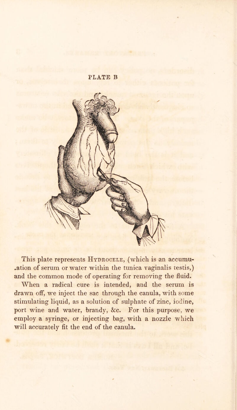 This plate represents Hydrocele, (which is an accumu- .ation of serum or water within the tunica vaginalis testis,) and the common mode of operating for removing the fluid. When a radical cure is intended, and the serum is drawn off, we inject the sac through the canula, with some stimulating liquid, as a solution of sulphate of zinc, iodine, port wine and watnr, brandy, &c. For this purpose, we employ a syringe, or injecting bag, with a nozzle which will accurately fit the end of the canula.