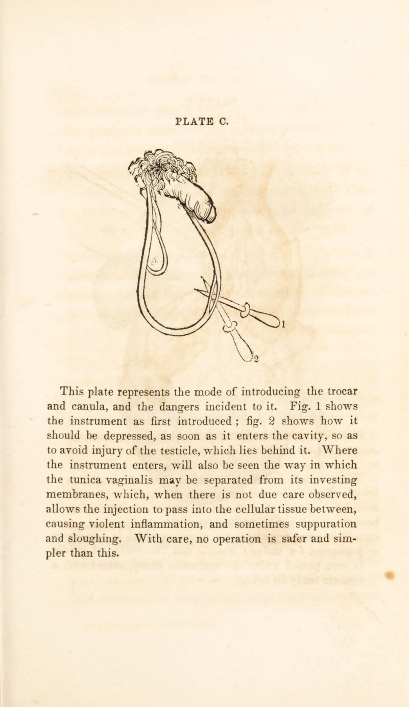 This plate represents the mode of introducing the trocar and canula, and the dangers incident to it. Fig. 1 shows the instrument as first introduced ; fig. 2 shows how it should be depressed, as soon as it enters the cavity, so as to avoid injury of the testicle, which lies behind it. Where the instrument enters, will also be seen the way in which the tunica vaginalis may be separated from its investing membranes, which, when there is not due care observed, allows the injection to pass into the cellular tissue between, causing violent inflammation, and sometimes suppuration and sloughing. With care, no operation is safer and sim- pler than this.