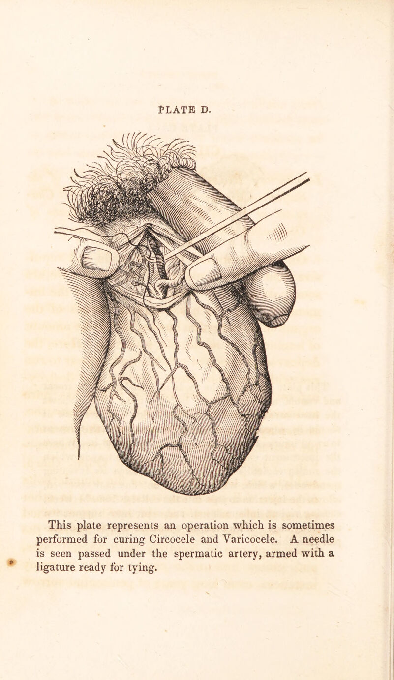 This plate represents an operation which is sometimes performed for curing Circocele and Varicocele. A needle is seen passed under the spermatic artery, armed with a ligature ready for tying.