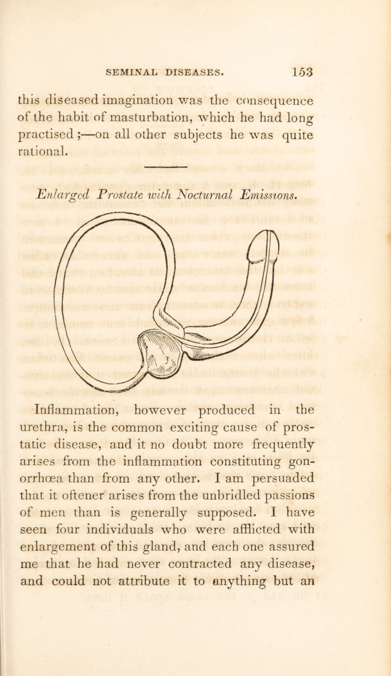 this diseased imagination was the consequence of the habit of masturbation, which he had long practised ;—on all other subjects he was quite rational. Enlarged Prostate with Nocturnal Emissions. Inflammation, however produced in the urethra, is the common exciting cause of pros- tatic disease, and it no doubt more frequently arises from the inflammation constituting gon- orrhoea than from any other. I am persuaded that it oftener arises from the unbridled passions of men than is generally supposed. I have seen four individuals who were afflicted with enlargement of this gland, and each one assured me that he had never contracted any disease, and could not attribute it to anything but an