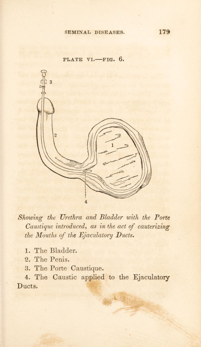 PLATE VI. FIG. 6. Showing' the Urethra and Bladder with the Porte Caustique introduced, as in the act of cauterizing the Mouths of the Ejacidatory Ducts, 1. The Bladder. 2. The Penis. 3. The Porte Caustique. 4. The Caustic applied to the Ejaculatory Ducts.