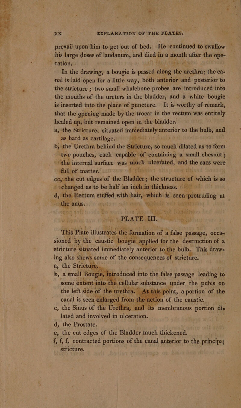 Pa Ya EXPLANATION OF THE PLATES. prevail upon him to get out of bed. He ‘continued to swallow his large doses of laudanum, and died 1 in a month after the ope- Fite): Saliibehiagh ty In the drawing, a bougie i is passed along the urethra; the ca- nal is laid open for a little way, both anterior and posterior to the stricture ; two small whalebone probes are introduced into the mouths of the ureters in the bladder, and a white bougie is inserted into the place of puncture. It is worthy of remark, that the opening made by the trocar in the rectum was entirely healed up, but remained open in the bladder. a, the Stricture, situated immediately anterior to wi bulb, and | as hard as cartilage. eee | b, the Urethra behind the Siiterure, so weit dilated as to form ‘two pouches, each capable’ of containing a small chesnut 5 “the internal surface was much ‘ulcerated, and the sacs were full of matter. a oy the cut edges of the Bladder ; the structure - which i is Se _ changed as to be half an inch in thickness. :- a (een mectum stuffed. with hair, « which is seen: protruding at P hag : . ‘aiihign t : : is Oh aw »PLATE MIT, 0, any This Plate illustrates the A oN or a false passage, occas He sioned by. the caustic bougie. a oplied 1 for the destruction of a stricture situated immediately anterior to the bulb. This draw- ing also shews some of the consequences of stricture. a, the Stricture,. b, a small Bougie, | 2 ntroduced into the false passage leading to some extent into the. cellular substance, under the pubis on the left side of the urethra, | At is point, a portion of the canal is seen enlarged from wl ion of the caustic. c, the Sinus of the Urethra, and “its: membranous portion die lated and involved in rite d, the Prostate. e, the cut edges of the Bladder much thickened. f, f, f, contracted portions of the canal anterior to the principa] stricture.