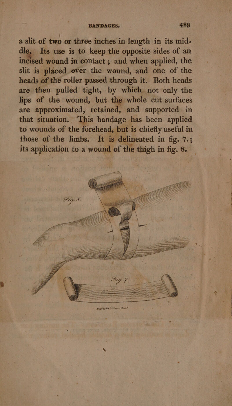 a slit of two or three inches in length in its mid- dle, Its use is to keep the opposite sides of an incised wound in contact ; and when applied, the slit is placed over the woud, and one of the heads of the roller passed through it. Both heads are then pulled tight, by which not only the lips of the wound, but the whole cut surfaces are approximated, retained, and supported in that situation. This and see has been applied to wounds of the forehead, but i is chiefly useful in those of the limbs. It is delineated in fig. 7.5 - A \ Aa ne A aN LS is -
