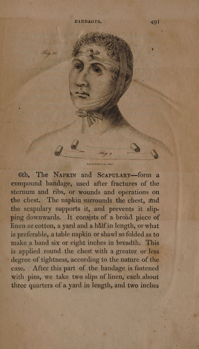Engihy K&amp;D Gizars Bdint 6th, The Napxin and Scapurary—form a compound bandage, used after fractures of the sternum and ribs, or wounds and operations on the chest. ‘The napkin surrounds the chest, and the scapulary supports it, and prevents it slip- ping downwards. It consists of a broad piece of linen or cotton, a yard and a half in length, or what is preferable, a table napkin or shawl so folded as to _ -make a band six or eight inches in breadth. This is applied round the chest with a greater or less ' degree of tightness, according to the nature of the case. ‘After this part of the bandage is fastened with pins, we take two slips of linen, each about three quarters of a yard in length, and two inches