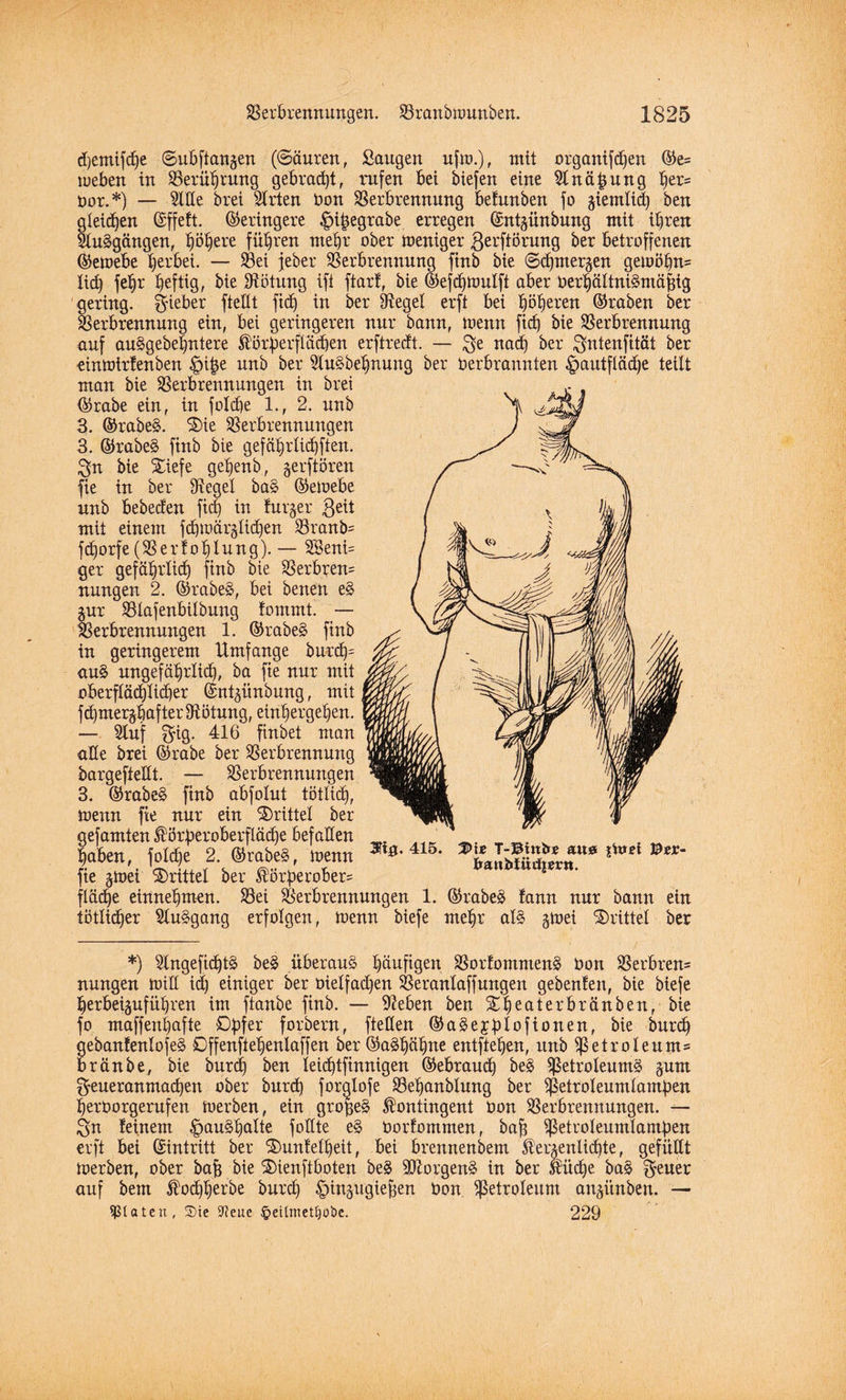 d)emifd)e ©ubftangen (Säuren, Saugen ufw.), mit organifdien ©e= meben in Verührung gebracht, rufen bei biefen eine Slnähung f>er= Oor.*) — Sille brei Wirten Oon Verbrennung befunben fo ^entlief) ben gleiten (Sffeft. Geringere begrabe erregen Sntgünbung mit ihren SluSgängen, ^ö|ere führen mehr ober weniger $erftörung ber betroffenen ©ewebe herbei. — Vei jeber Verbrennung finb bie Schmerzen gewöhn= lieh fehr heftiQ, bie Rötung ift ftarf, bie ©efdjwutft aber oerhältniSmäfjig gering, lieber fteüt ftef) in ber Siegel erft bei höheren (traben ber Verbrennung ein, bei geringeren nur bann, wenn fid) bie Verbrennung auf auSgebeljntere Körperflächen erftreeft. — ^e nad) ber $ntenfität ber einwirtenben £ipe unb ber StuSbehnung ber Oerbrannten £>autfläd)e teilt man bie Verbrennungen in brei @rabe ein, in folcpe 1., 2. unb 3. ®rabe§. S)ie Verbrennungen 3. ©rabeS finb bie gefährlichen. 3n bie Siefe gehenb, jerftören fie in ber Siegel ba§ ©ewebe unb bebeefen fiep in furjer $eit mit einem fchwärglichen Vranä= fdjorfe (Verfehlung).— SBeni= ger gefährlich finb bie Verbrem nungen 2. ©rabeS, bei benen e§ Zur Vlafenbilbung fornrnt. — Verbrennungen 1. ©rabeS finb in geringerem Umfange burd)= au§ ungefährlich, ba fie nur mit oberflächlicher (Sntzitnbung, mit fchmerghufter Rötung, einhergehen. — Stuf $ig. 416 finbet man üüe brei ©rabe ber Verbrennung bargefteüt. — Verbrennungen 3. ©rabeS finb abfolut tätlich, Wenn fie nur ein drittel ber gefamten Körperoberflädje befallen haben, foldje 2. ©rabeS, wenn fie gwei drittel ber Körperober= fläche einnehmen. Vei Verbrennungen 1. ©rabeS !ann nur bann tätlicher StuSgang erfolgen, wenn biefe mehr als gwei drittel m&. 415. T-Btnir® aust jtod #£*- franbltttfimt. ein ber *) SlngefichtS be§ überaus häufigen VorfommenS Oon Verbren= nungen Will id) einiger ber oielfadjen Veranlaffungen gebeuten, bie biefe herb erführen im ftanbe finb. — Sieben ben Theater bränben, bie fo maffenhafte Opfer forbern, fteflen ©aSejplofionen, bie burd) gebanfenlofeS Offenftepenlaffen ber©aShähtw entftehen, unb Petroleum* bränbe, bie burdf ben leichtfinnigen (Gebrauch beS VetroleumS jum geueranmaepen ober burch foralofe Vehanblung ber ^SetroXeumtampcn herüorgerufen werben, ein gropeS Kontingent oon Verbrennungen. — Qn feinem §au3palte fottte eS Oorfommen, baff VeUoleumlampen erft bei ©intritt ber SJuntelpeit, bei brennenbem Kerzenlichte, gefüllt werben, ober bafc bie 5)ienftboten beS Borgens in ber Küche baS $euer auf bem Kochherbe burch ^injttjgtejjen oon Petroleum anjünbett. — ißtateu, Sie SReuc §eilmet|obe. 229