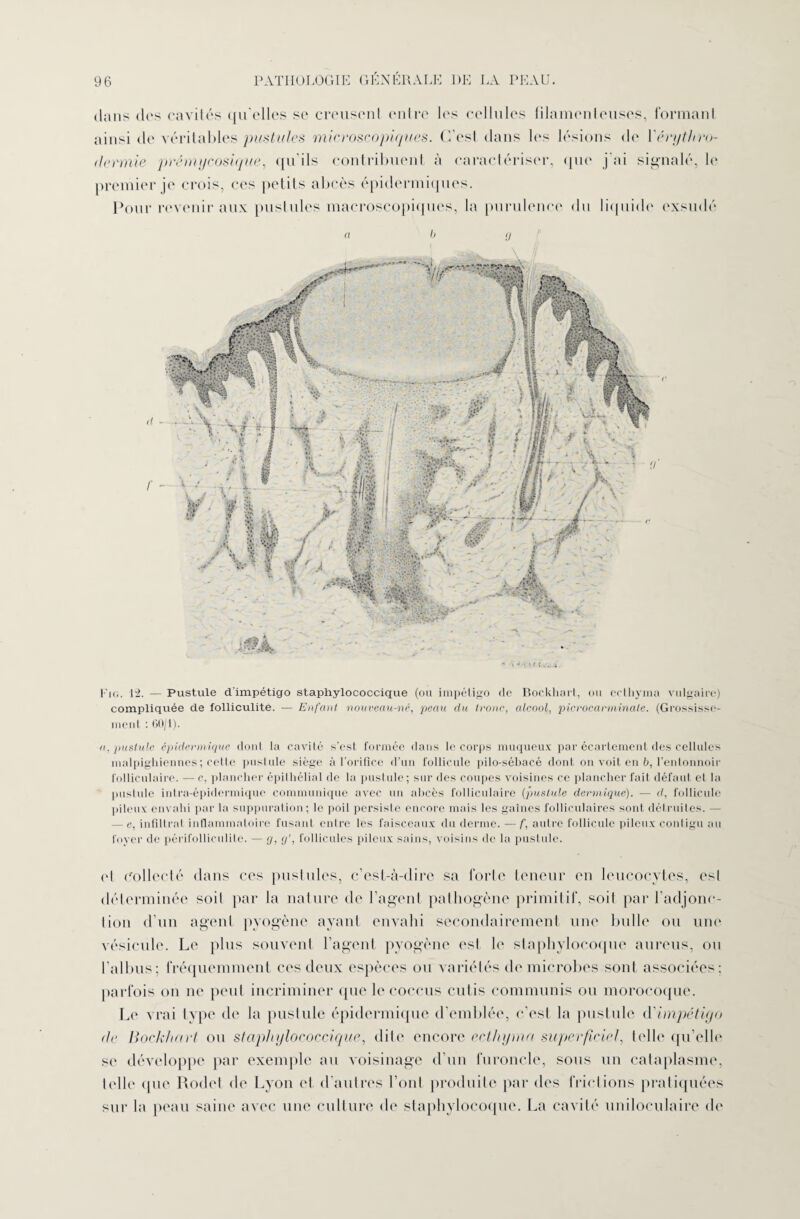 l u.. 12. — Pustule d'impétigo staphylococcique (ou impétigo de Bockhail, ou eethyma vulgaire) compliquée de folliculite. — Enfant nouveau-né, peau du tronc, alcool, picrocarniinale. (Grossisse¬ ment : 60/1). a, pustule épidermique donl la cavité s'esl formée dans le corps muqueux par écartement des cellules malpighiennes; cette pustule siège à l’orifice d’un follicule pilo-sébacé dont on voit en b, l’entonnoir folliculaire. — c, plancher épilhélial de la pustule; sur des coupes voisines ce plancher fait défaut el la pustule intra-épidermique communique avec un abcès folliculaire (pustule dermique). — d, follicule pileux envahi par la suppuration; le poil persisle encore mais les gaines folliculaires sont détruites. — — e, infiltrat inflammatoire fusant entre les faisceaux du derme. — f, autre follicule pileux contigu au foyer de périfolliculilc. — g, g', follicules pileux sains, voisins de la pustule. cl Collecté dans ces pustules, c’est-à-dire sa forte teneur en leucocytes, esl déterminée soit par la nature de l’agent pathogène primitif, soil par l’adjonc¬ tion d’un agent pyogène ayant envahi secondairement une bulle ou une vésicule. Le plus souvent l’agent pyogène est le staphylocoque aureus, ou 1’albus; fréquemment ces deux espèces ou variétés de microbes sont associées; parfois on ne peut incriminer que le eoccus cutis communis ou morocoque. Le vrai type de la pustule épidermique d’emblée, c’est la pustule d'impétigo de Bockhart ou staphylococcique, dite encore eethyma superficiel, telle qu’elle se développe par exemple au voisinage d'un furoncle, sous un cataplasme, telle ipie Rodet de Lyon et d'autres l’ont produite par des frictions pratiquées sur la peau saine avec une culture de staphylocoque. La cavité uniloculaire de 96 PATHOLOGIE GÉNÉRALE I)E LA PEAU. dans des cavités qu elles se creusent entre les cellules filamenteuses, formant ainsi de véritables pustules microscopiques, ('/est dans les lésions de l'érythro¬ dermie prémycosique, qu’ils contribuent à caractériser, que j’ai signalé, h* premier je crois, ces petits abcès épidermiques. Pour revenir aux pustules macroscopiques, la purulence du liquide exsudé a b g
