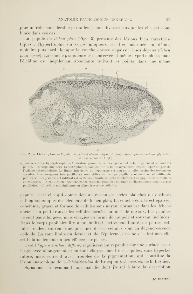 joue un rôle considérable parmi les lésions diverses auxquelles elle est com¬ binée dans ces cas. La papule de lichen plan (Fig. i 5) présente des lésions bien caractéris¬ tiques : l’hypertrophie du corps muqueux est très marquée au début, moindre plus tard, lorsque la couche cornée s’épaissit à ses dépens (lichen plan corné). La couche granuleuse est conservée et même hypertrophiée, mais l’éléidine est inégalement abondante, suivant les points, dans une meme Fig. 15. — Lichen plan. — Papule 1res petite et récente; région du flanc; alcool, picrocarminate, glycérine. (Grossissement : 115/1.) a, couche cornée hyperplasique. — 6, stratum granulosum très épaissi, et cela inégalement suivant les points. — c, corps muqueux hypertrophique, composé de cellules agrandies, larges, séparées par de l’œdème intercellulaire. La limite inférieure de l’épiderme est peu nette; elle dessine des festons ou arcades. Les bourgeons interpapillaires sont effilés.—d, corps papillaire œdémateux et infiltré de petites cellules jeunes; cet infiltrât est nettement limité du côté du chorion. Les papilles sont renflées en coupoles. — e, cellules en dégénérescence colloïde, groupées en amas ou disséminées dans le corps papillaire. — /’, cellule malpighienne en dégénérescence colloïde. papule; c’est elle qui donne lieu au réseau de slries blanches ou opalines pathognomoniques des éléments de lichen plan. La couche cornée est épaisse, cohérente, grasse et formée de cellules sans noyau, normales; dans les lichens anciens on peut trouver les cellules cornées munies de noyaux. Les papilles ne sont pas allongées, mais élargies en forme de coupole et souvent inclinées. Dans le corps papillaire il y a un infiltrat, nettement limité, de petites cel¬ lules rondes; souvent quelques-unes de ces cellules sont en dégénérescence colloïde. La zone limite du derme et de l'épiderme dessine des festons; elle est habituellement un peu effacée par places. C’est Yhyperacanthose diffuse, régulièrement répandue sur une surface assez large, avec allongement et surtout élargissement des papilles, sans hyperké- ratose, mais souvent avec troubles de la pigmentation, qui constitue la lésion anatomique de la lichénification de Brocq ou lichénisation deE. Besnier. Signalons, en terminant, une maladie dont j’aurai à taire la description