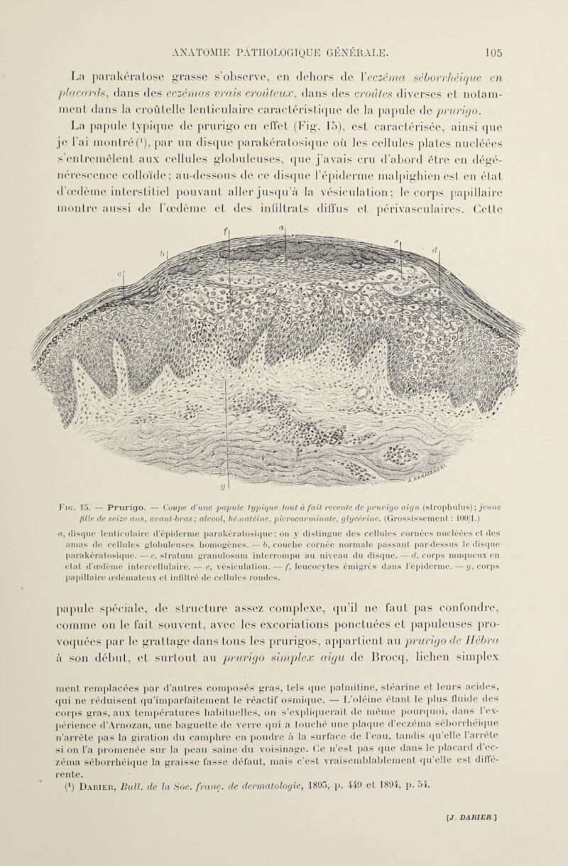 La parakératose grasse s'observe, en dehors de l'eczéma séborrhéique en placards, dans des eczémas vrais croit leux, dans des croûtes diverses et notam¬ ment dans la croûtelle lenticulaire caractéristique de la papule de prurigo. La papule typique de prurigo en effet (Fig. là), est caractérisée, ainsi que je l'ai montré(*), par un disque parakératosique où les cellules plates nucléées s’entremêlent aux cellules globuleuses, que j’avais cru d’abord être en dégé¬ nérescence colloïde; au-dessous de ce disque l’épiderme malpighien est en état d’œdème interstitiel pouvant aller jusqu’à la vésiculation; le corps papillaire montre aussi de 1 œdème et des in filtrats diffus et périvasculaires. Cette $10/ f ® a\%©-*0 V i £ • &. iS-k'dyi. Fig. lo. — Prurigo. — Coupe d’une papule typique tout à fait recente de prurigo aigu (slropkulus); jeune fille de seize ans, avant-bras; alcool, hématéine. picrocarminale, glycérine. (Grossissement : 100/1.) a, disque lenticulaire d’épiderme parakératosique ; on y distingue des cellules cornées nucléées et des amas de cellules globuleuses homogènes. — b, couche cornée normale passant par-dessus le disque parakératosique. — c, slralum granulosum interrompu au niveau du disque. — d, corps muqueux en étal d'œdème intercellulaire.— e, vésiculation.— f, leucocytes émigrés dans l’épiderme. — g, corps papillaire œdémateux et infiltré de cellules rondes. papule spéciale, de structure assez complexe, qu'il ne faut pas confondre, comme on le fait souvent, avec les excoriations ponctuées et papuleuses pro¬ voquées par le grattage dans tous les prurigos, appartient au prurigo de Hébra à son début, et surtout au prurigo simplex aigu de Brocq, lichen simplex ment remplacées par d’autres composés gras, tels que palmiline, stéarine et leurs acides, qui ne réduisent qu’imparfaitement le réactif osmique. — L’oléine étant le plus fluide des corps gras, aux températures habituelles, on s’expliquerait de même pourquoi, dans 1 ex¬ périence d’Arnozan, une baguette de verre qui a louché une plaque d’eczéma séborrhéique n’arrête pas la giration du camphre en poudre à la surface de 1 eau. tandis qu’elle 1 arrête si on l’a promenée sur la peau saine du voisinage. Ce n’est pas que dans le placard d ec¬ zéma séborrhéique la graisse fasse défaut, mais c’est vraisemblablement qu elle est diffé¬ rente. C) Darier, Bull, de la Soc. franc, de dermatologie, 1893, p. 449 et 1894, p. 54.