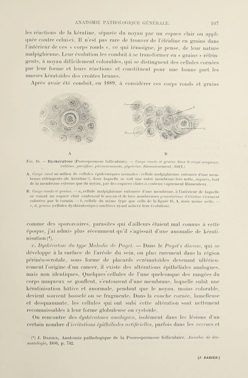 les réactions de la kératine, séparée du noyau par un espace clair ou appli¬ quée contre celui-ci. Il n est pas rare de trouver de l éléidine en grains dans 1 intérieur de ces « corps ronds », ce qui témoigne, je pense, de leur nature malpighienne. Leur évolution les conduit à se transformer en « grains » réfrin¬ gents, a noyau dilficilement colorables, qui se distinguent des cellules cornées par leur forme et leurs réactions et constituent pour une bonne part les masses kératoïdes des croûtes brunes. Après avoir été conduit, en 1889, à considérer ces corps ronds et grains a n Fig. IG. — Dyskératose (Psorospennose folliculaire). — Corps ronds cl grains dans le corps muqueux; sublime, paraffine, picrocarminate, glycérine. (Grossissement : 650/1.) A. Corps rond au milieu de cellules épidermiques normales : cellule malpighienne entourée d’une mem¬ brane réfringente (de kératine?), dans laquelle se voit une autre membrane très nelle, séparée, tant de la membrane externe que du noyau, par des espaces clairs à contenu vaguement filamenteux. B. Corps ronds et grains. — a>cellule malpighienne entourée d'une membrane, à l’intérieur de laquelle se voient un espace clair contenant le noyau et de très nombreuses granulations d'éléidine vivement colorées par le carmin. —b, cellule du même type que celle de la figure 16, A, mais moins nette. — c, d, grains (cellules dyskératosiques nueléces ayant achevé leur évolution). comme des sporozoaires, parasites qui d'ailleurs étaient mal connus à celte époque, j’ai admis plus récemment qu’il s’agissait d’une anomalie de kérati¬ nisation (1). c. Dyskératose du type Maladie de Paget. — Dans le Paget's diseuse, qui se développe à la surface de l’aréole du sein, ou plus rarement dans la région périnéo-scrotale, sous forme de placards eczématoïdes devenant ultérieu¬ rement l’origine d’un cancer, il existe des altérations épithéliales analogues, mais non identiques. Quelques cellules de l’une quelconque des rangées du corps muqueux se gonflent, s’entourent d’une membrane, laquelle subit une kératinisation hâtive et anormale, pendant que le noyau, moins colorable, devient souvent bosselé ou se fragmente. Dans la couche cornée, lamelleuse et desquamante, les cellules qui ont subi celle altération sont nettement reconnaissables à leur forme globuleuse ou cystoïde. On rencontre des dyskératoses analogues, isolément dans les lésions d’un certain nombre t\'irritations épithéliales artificielles, parfois dans les verrues et (*) J. Darier, Anatomie pathologique de la Psorospennose folliculaire. Annales de der¬ matologie, 1896, p. 742.