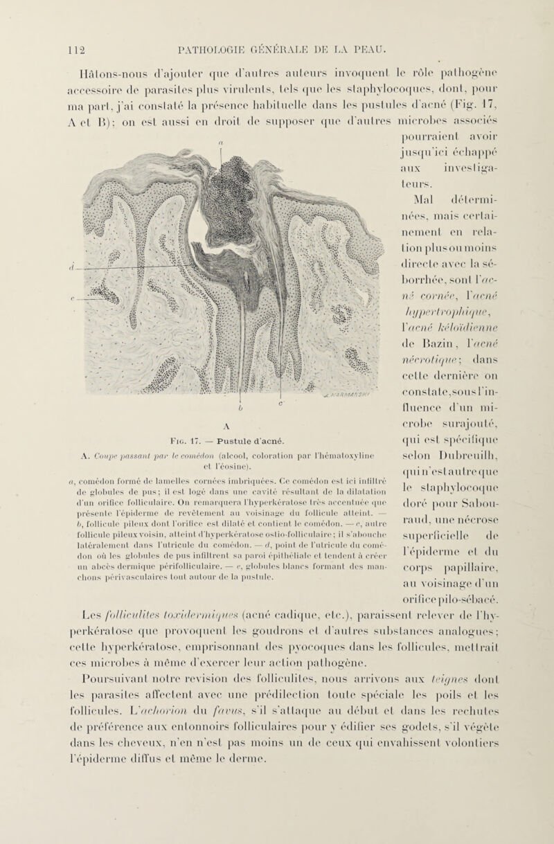 IIAlons-nous d’ajouter que d’autres auteurs invoquent le rôle pathogène accessoire de parasites plus virulents, tels que les staphylocoques, dont, pour ma pari, j'ai constaté la présence habituelle dans les pustules d acné (Fig. I, A et B); on est aussi en droit de supposer que d'autres microbes associés A Fig. 17. — Pustule d'acné. pourraient avoir jusqu ici échappé aux investiga¬ teurs. Mal détermi¬ nées, mais certai¬ nement en rela- t ion plus ou moins directe avec la sé¬ borrhée, sont l’ftC- né cornée, Y acné hypertrophique, l'acné kéloïdicnne de Bazin, Y acné nécrotique; dans celle dernière on constate,sous l'in¬ fluence d’un mi¬ crobe surajouté, qui est spécifique A. Coupe passant par le comédon (alcool, coloration par l’hémaloxyline et l’éosine). «, comédon formé de lamelles cornées imbriquées. Ce comédon est ici infiltré de globules de pus; il est logé dans une cavité résultant de la dilatai ion d’un orifice folliculaire. On remarquera l’hyperkcratose très accentuée que présente l’épiderme de revêtement au voisinage du follicule atteint. — b, follicule pileux dont l’orifice est dilaté et contient le comédon. —c, autre follicule pileux voisin, atteint d’hyperkératose osl io-follieulaire ; il s’abouche latéralement dans l'utricule du comédon.—d, point de l'utricule du comé¬ don où les globules de pus infiltrent sa paroi épithéliale et tendent à créer un abcès dermique périfolliculaire. — e, globules blancs formant des man¬ chons périvasculaires tout autour de la pustule. Les folliculites toxidermiques (acné cadique, etc.), paraissent relever de l’hv- perkératose que provoquent les goudrons et d'autres substances analogues; celle hyperkératose, emprisonnant des pyocoques dans les follicules, met Irait ces microbes à même d’exercer leur action pathogène. Poursuivant notre révision fies folliculites, nous arrivons aux teigne.s dont les parasites affectent avec une prédilection toute spéciale les poils et les follicules. L'achorion du fctvus, s’il s’attaque au début et dans les rechutes de préférence aux entonnoirs folliculaires pour y édifier ses godets, s'il végète dans les cheveux, n’en n’est pas moins un de ceux qui envahissent volontiers l’épiderme diffus et même le derme. selon Dubreuilh, quin’estautreque le staphylocoque doré pour Sabou- raud, une nécrose superficielle de l’épiderme el du corps papillaire, au voisinage d’un orifice pilo-sébacé.