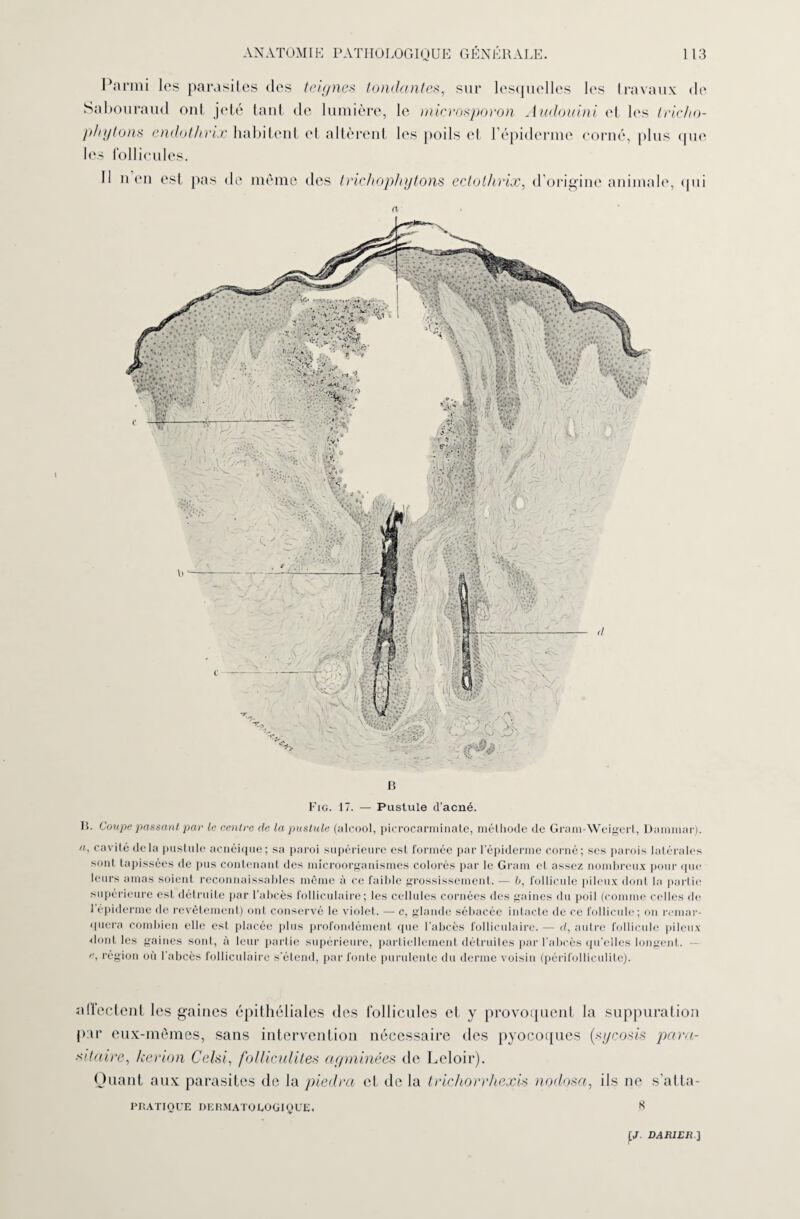 Parmi les parasites des teignes tondantes, sur lesquelles les travaux de Sabouraud oui jeté tant de lumière, le microsporon Audouini et les tricho- phytons endothrix habitent el altèrent les poils et l’épiderme corné, plus que les follicules. Il nen est pas de meme des trichophytons ectothrix, d’origine animale, qui a H. Coupc passant pat- le centre de la pustule (alcool, pierocarminate, méthode de Gram-Weigert, Dammar). a, cavité delà pustule acnéique; sa paroi supérieure est formée par l’épiderme corné; ses parois latérales sont tapissées de pus contenant des microorganismes colorés par le Gram et assez nombreux pour que leurs amas soient reconnaissables même à ce faible grossissement. — b, follicule pileux dont la partie supérieure est détruite par l’abcès folliculaire; les cellules cornées des gaines du poil (comme celles de 1 épiderme de revêtement) ont conservé le violet. — c, glande sébacée intacte de ce follicule; on remar¬ quera combien elle est placée plus profondément que l’abcès folliculaire. — d, autre follicule pileux dont les gaines sont, à leur partie supérieure, partiellement détruites par l’abcès qu’elles longent, région où l’abcès folliculaire s’étend, par fonte purulente du derme voisin (périfolliculite). affectent les gaines épithéliales des follicules et y provoquent la suppuration par eux-mêmes, sans intervention nécessaire des pyocoques (xycosis para¬ sitaire, kerion Celsi, folliculites agminées de Leloir). Quant aux parasites de la piedra et de la trichorrhexis nodosa, ils ne s’atta- PRATIOUE DERMATOLOGIQUE. H