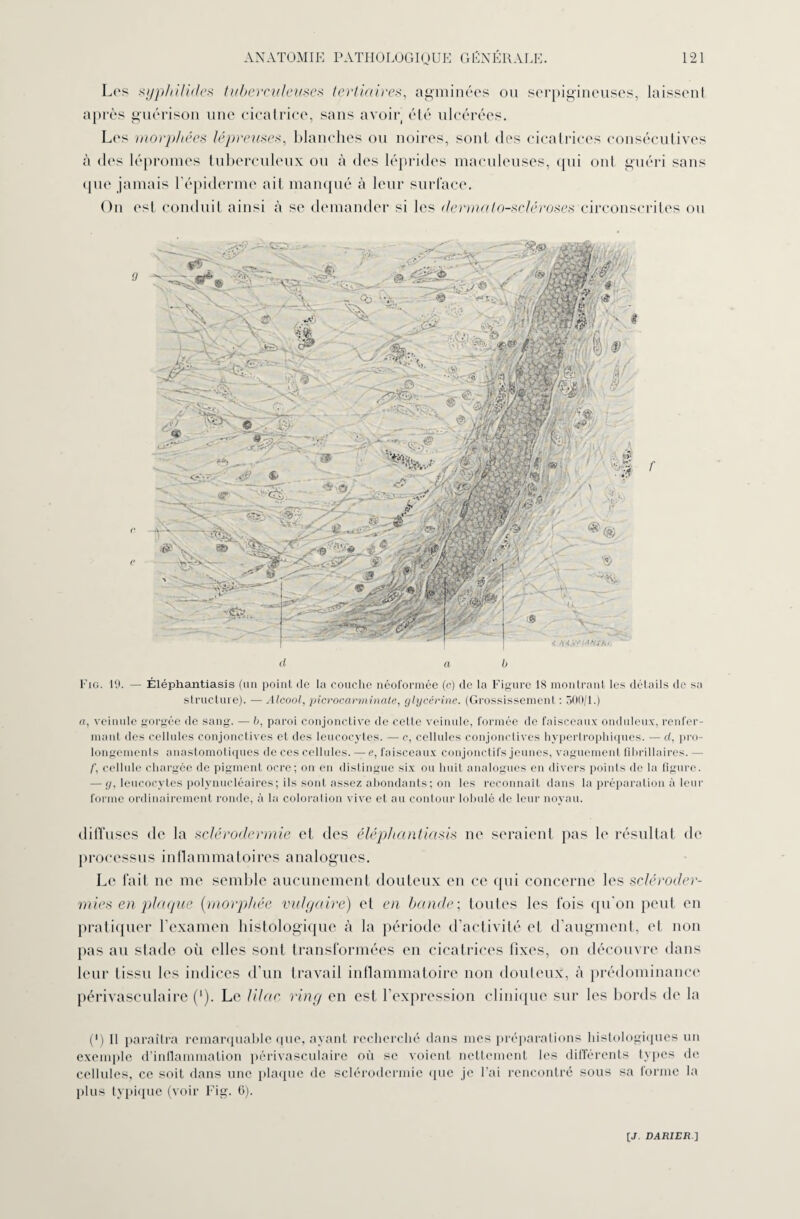 Les syp/iilides tuberculeusea tertiaires, agminées ou serpigineuses, laissent après guérison une cicatrice, sans avoir, été ulcérées. Les morphées lépreuses, blanches ou noires, sont des cicatrices consécutives à des lépromes tuberculeux ou à des léprides maculeuses, qui ont guéri sans que jamais l'épiderme ait manqué à leur surface. On est conduit ainsi à se demander si les dermalo-scléroses circonscrites ou d a b Fig. 10. — Éléphantiasis (un point de la couche néoformée (c) de la Figure 18 montrant les détails de sa structure). — Alcool, picrocarminale, glycérine. (Grossissement : 500/1.) a, veinule gorgée de sang. — b, paroi conjonctive de celte veinule, formée de faisceaux onduleux, renfer¬ mant des cellules conjonctives et des leucocytes. — c, cellules conjonctives hypertrophiques. — d, pro¬ longements anastomotiques de ces cellules. — e, faisceaux conjonctifs jeunes, vaguement fihrillaires. — f, cellule chargée de pigment ocre; on en distingue six ou huit analogues en divers points de la figure. — y, leucocytes polynucléaires; ils sont assez abondants; on les reconnaît dans la préparation à leur forme ordinairement ronde, à la coloration vive et au contour lobule de leur noyau. diffuses de la sclérodermie et des éléphantiasis ne seraient pas le résultat de processus inflammatoires analogues. Le fait ne me semble aucunement douteux en ce (pii concerne les scléroder¬ mies en plaque (morphée vulgaire) et en bande; toutes les fois qu'on peut en pratiquer l'examen histologique à la période d’activité et d'augment, et non pas au stade où elles sont transformées en cicatrices fixes, on découvre dans leur tissu les indices d’un travail inflammatoire non douteux, à prédominance périvasculaire (‘). Le lilac ring en est l’expression clinique sur les bords de la C) Il paraîtra remarquable que, ayant recherché dans mes préparations histologiques un exemple d’inflammation périvasculaire où se voient nettement les différents types de cellules, ce soit dans une plaque de sclérodermie que je l’ai rencontré sous sa lorme la plus typique (voir Fig. 6).