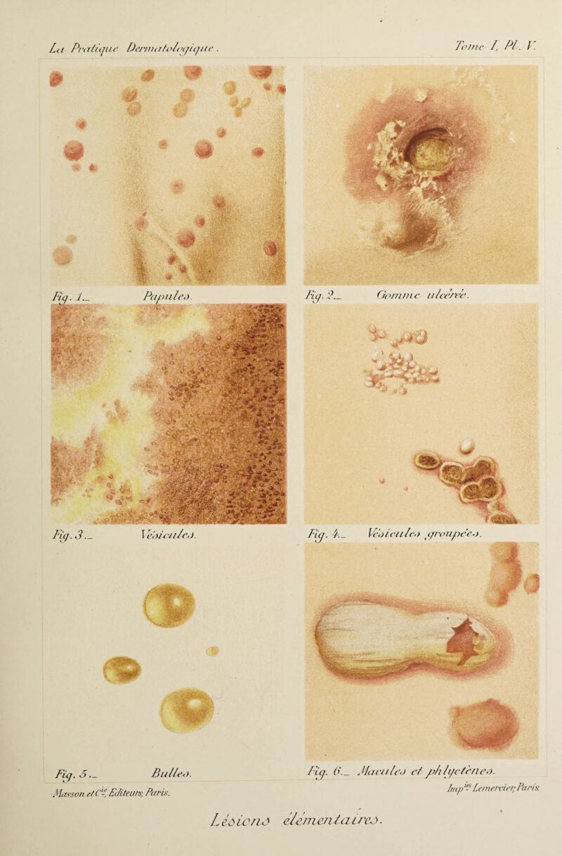 La Pratique 9 * te %-3~ Fÿ-5- Mttsson rtC1-, DenuatoltHjique. T eiucllL Tonte T, PI. V <<* •t Ve\j ien /eo ( groupée, o. Bulle*). Hteunr, Pu ris. Fia. 6\_ J la ci t/c,) et ph h/ctènen. Imp LemerviepParis. L là ionô e/em enlaii vo