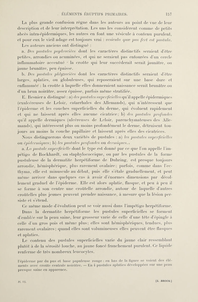 La plus grande confusion règne dans les auteurs au point de vue de leur description et de leur interprétation. Les uns les considèrent comme de petits abcès intra-épidermiques, les autres en font une vésicule à contenu purulent, et pour eux le vieil adage est toujours vrai : vesicula quæ pu* fert est pustulci. Les auteurs anciens ont distingué : a. Des pustules psydmciées dont les caractères distinctifs seraient d’être petites, arrondies ou acuminées, et qui ne seraient pas entourées d’un cercle inflammatoire accentué * la croûte qui leur succéderait serait jaunâtre, ou jaune brunâtre, peu épaisse. b. Des pustules phlyzaciées dont les caractères distinctifs seraient d’être larges, aplaties, ou globuleuses, qui reposeraient sur une base dure et enflammée* : la croûte à laquelle elles donneraient naissance serait brunâtre ou d’un brun noirâtre, assez épaisse, parfois même stratifiée. E. Besnier a distingué : a) des pustules superficielles qu’il appelle épidermiques (exulcéreuses de Leloir, catarrhales des Allemands), qui n’intéressent que l’épiderme et les couches superficielles du derme, qui évoluent rapidement et qui ne laissent après elles aucune cicatrice; b) des pustules profonde* qu’il appelle dermiques (ulcéreuses de Leloir, parenchymateuses des Alle¬ mands), qui intéressent plus ou moins profondément le derme, détruisent tou¬ jours au moins la couche papillaire et laissent après elles des cicatrices. Nous distinguerons deux variétés de pustules : a) les pustules superficielles ou épidermiques ; b) les pustules profondes ou dermiques.. a. La pustule superficielle dont le type est donné par ce que l'on appelle l’im¬ pétigo de Bockhardt, ou staphylococcique, ou par les pustules de la forme pustuleuse de la dermatite herpétiforme de Duhring, est presque toujours arrondie, hémisphérique, plus rarement ovalaire; parfois, comme dans l’ec- thyma, elle est minuscule au début, puis elle s’étale graduellement, et peut même arriver dans quelques cas à avoir d’énormes dimensions par décol¬ lement graduel de l'épiderme. Elle est alors aplatie, flasque, et peu à peu il se forme à son centre une croûlelle arrondie, autour de laquelle d’autres croûlelles plus jeunes peuvent prendre naissance, à mesure que la lésion per¬ siste et s’étend. Ce même mode d’évolution peut se voir aussi dans l'impétigo herpétiforme. Dans la dermatite herpétiforme les pustules superficielles se forment d’emblée sur la peau saine, leur grosseur varie de celle d'une tête d’épingle à celle d’un gros pois et même plus; elles sont hémisphériques, tendues, plus rarement ovalaires; quand elles sont volumineuses elles peuvent être flasques et aplaties. Le contenu des pustules superficielles varie du jaune clair ressemblant plutôt à de la sérosité louche, au jaune foncé franchement purulent. Ce liquide renferme de très nombreux leucocytes. l’épiderme par du pus et base papuleuse rouge : en bas de la figure se voient des élé¬ ments avec croûte centrale noirâtre. — En 4 pustules aplaties développées sur une peau presque saine en apparence. PI. 17.