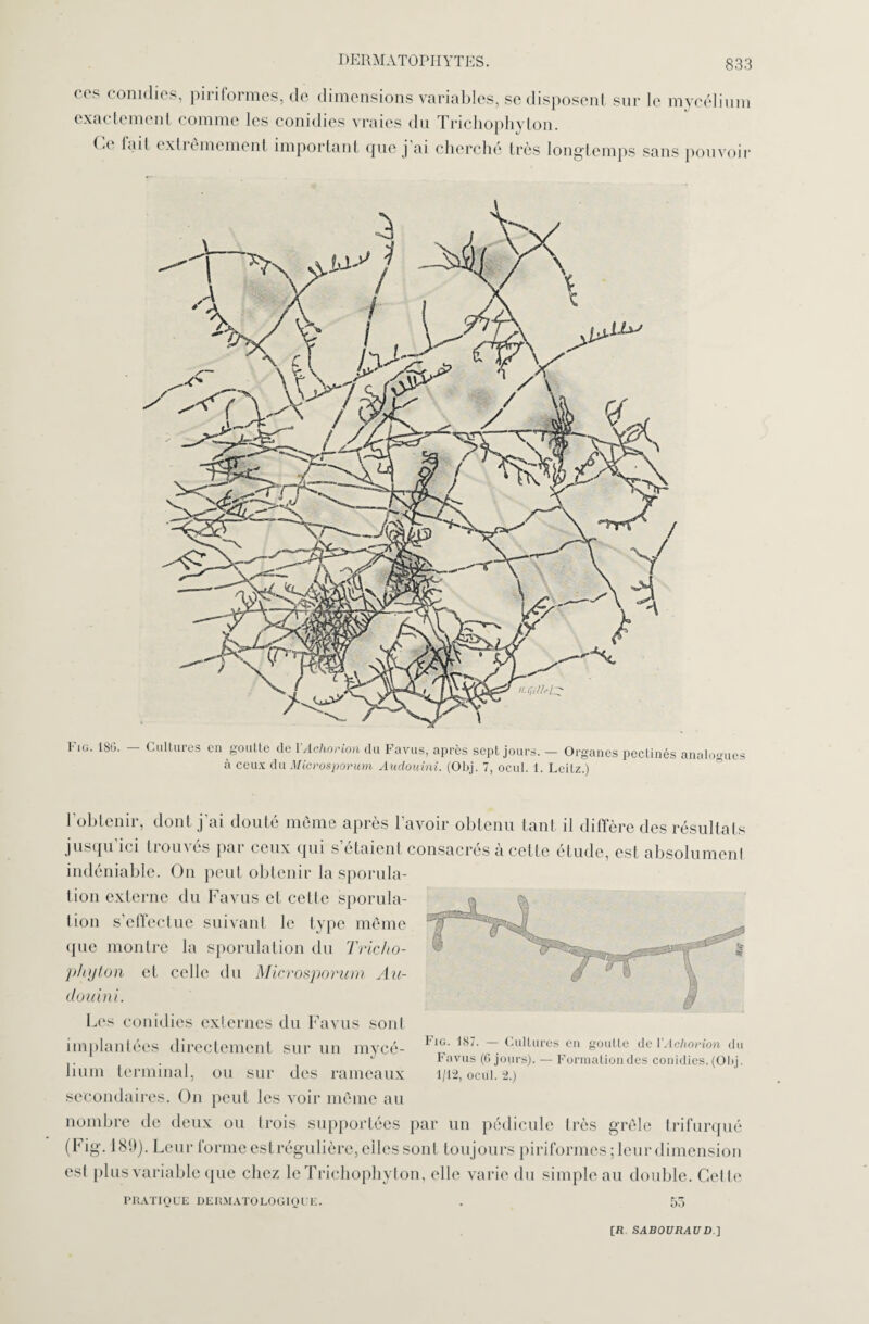 cos conidies, piriformes, do dimensions variables, se disposent sur le mycélium exactement comme les conidies vraies du Trichophyton. Ce fait extrêmement important que j’ai cherché très longtemps sans pouvoir à ceux du Microsporum Audouini. (Obj. 7, ocul. 1. Leitz.) l’obtenir, dont j’ai douté même après l’avoir obtenu tant il diffère des résultats jusqu’ici trouvés par ceux qui s’étaient consacrés à cette étude, est absolument indéniable. On peut obtenir la sporula¬ tion externe du Favus et cette sporula¬ tion s’effectue suivant le type même (pie montre la sporulation du Tricho¬ phyton et celle du Microsporum Au¬ douini. Les conidies externes du Favus sont implantées directement sur un mycé¬ lium terminal, ou sur des rameaux secondaires. On peut les voir même au nombre de deux ou trois supportées par un pédicule très grêle trifurqué (Fig. 189). Leur forme est régulière, elles sont toujours piriformes ; leur dimension est plus variable que chez le Trichophyton, elle varie du simple au double. Cette PRATIQUE DERMATOLOGIQUE. . 55 Fig. 187. — Cultures en goutte de YAchorion du Favus (6 jours). — Formation des conidies. (Obj. 1/12, ocül. 2.)