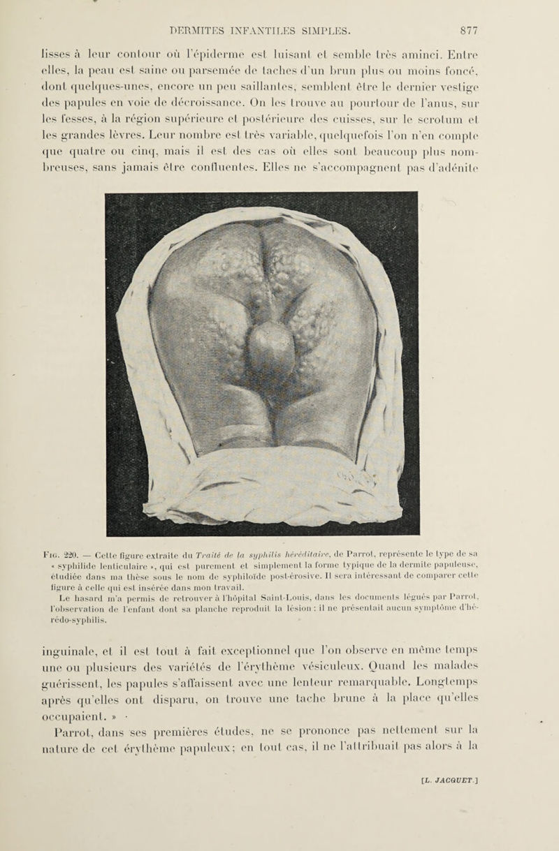 lisses à leur contour où l’épiderme est luisant et semble très aminci. Entre (dles, la peau est saine ou parsemée de taches d’un brun plus ou moins foncé, dont quelques-unes, encore un peu saillantes, semblent être le dernier vestige des papules en voie de décroissance. On les trouve au pourtour de l’anus, sur les fesses, à la région supérieure et postérieure des cuisses, sur le scrotum et les grandes lèvres. Leur nombre est très variable, quelquefois l’on n’en compte ([lie quatre ou cinq, mais il est des cas où elles sont beaucoup plus nom¬ breuses, sans jamais être continentes. Elles ne s’accompagnent pas d’adénite Fig. 220. — Celle figure extraite du Traité de la syphilis héréditaire, de Parrot, représente le type de sa « syphilide lenticulaire », cjui est purement et simplement la forme typique de la dermite papuleuse, étudiée dans ma thèse sous le nom de syphiloïde post-érosive. Il sera intéressant de comparer cette figure à celle qui est insérée dans mon travail. Le hasard m’a permis de retrouver à l’hôpital Saint-Louis, dans les documents légués par Parrot, l’observation de l’enfant dont sa planche reproduit la lésion: il ne présentait aucun symptôme d’hé- rédo-syphilis. inguinale, el il est tout à fait exceptionnel que l’on observe en même temps une ou plusieurs des variétés de 1 érythème vésiculeux. Quand les malades guérissent, les papules s'affaissent avec une lenteur remarquable. Longtemps après qu elles ont disparu, on trouve une tache brune à la place qu elles occupaient. » ■ Parrot, dans ses premières études, ne se prononce pas nettement sur la nature de cet érythème papulcux; en tout cas, il ne 1 attribuait pas alors a la