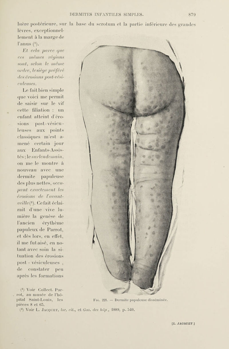 (*) Voir Collect. Par- rot, au musée de l’hô¬ pital Saint-Louis, les pièces 8 et 63. (â) Voir L. Jacquet, lac. cil., et Gaz Fig. 221. — Dermite papuleuse disséminée. des hôp., 1881», p. 311). bière postérieure, sur lèvres, exceptionnel¬ lement à la marge de l’anus (’). Et cela parce (pie ces mêmes régions mut, selon le même ordre, lesiège préféré de* érosions post-vési- c vie uses. Le fait bien simple que voici me permit de saisir sur le vif celte filiation : un enfant atteint d’éro¬ sions posl-vésieu- 1 eu ses aux points classiques m'est a- mené certain jour aux Enfants-Assis¬ tés; 1 e surlendemain, on me le montre à nouveau avec une dermite papuleuse des plus nettes, occu¬ pant exactement les érosions de Vavant- veille^). Ce fait éclai¬ rait d’une vive lu¬ mière la genèse de l’ancien érythème papuleux de Parrot, et dès lors, en effet, il me fut aisé, en no¬ tant avec soin la si¬ tuation des érosions post - vésiculeuses , de constater peu après les formations S