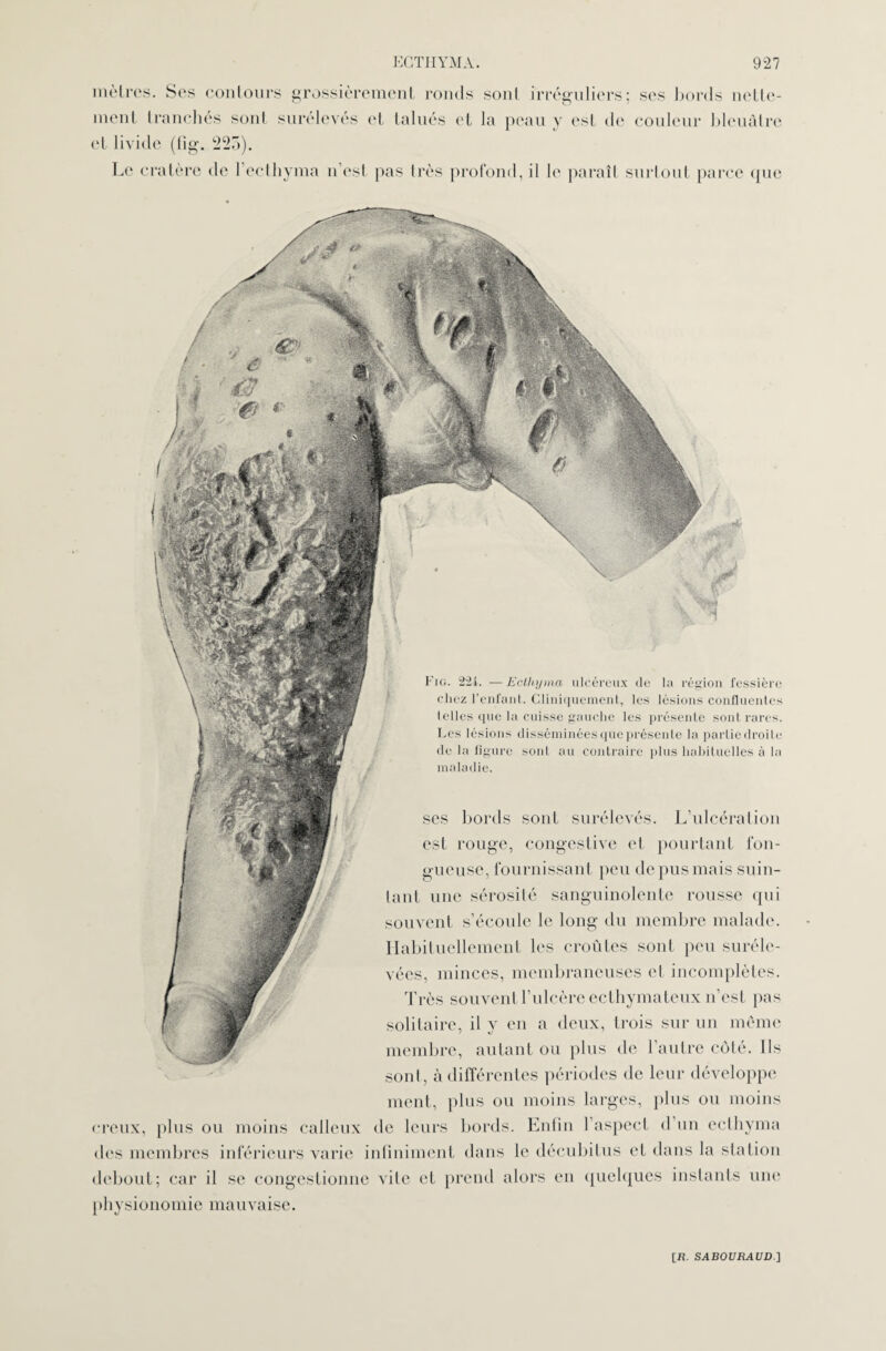 mètres. Ses contours grossièrement ronds sont irréguliers; ses bords nette¬ ment tranchés sont surélevés et talués et la peau y est de couleur bleuâtre et livide (tîg. 225). Le cratère de l’ecthyma n est pas très profond, il le paraît surtout parce que Fig. 221. —Ecthyma ulcéreux de la région fessière chez l’enfant. Cliniquement, les lésions confluentes telles que la cuisse gauche les présente sont rares. Les lésions disséminées que présente la partie droite de la figure sont au contraire plus habituelles à la maladie. ses bords sont surélevés. L’ulcération est rouge, congestive et pourtant fon¬ gueuse, fournissant peu de pus mais suin¬ tant une sérosité sanguinolente rousse qui souvent s’écoule le long du membre malade. Habituellement les croûtes sont peu suréle¬ vées, minces, membraneuses et incomplètes. Très souvent l’ulcère ecthymateux n’est pas solitaire, il y en a deux, trois sur un même membre, autant ou plus de l'autre côté. Ils sont, à différentes périodes de leur développe ment, plus ou moins larges, plus ou moins creux, plus ou moins calleux de leurs bords. Enfin l’aspect d’un ecthyma des membres inférieurs varie infiniment dans le décubitus et dans la station debout; car il se congestionne vite et prend alors en quelques instants une physionomie mauvaise.