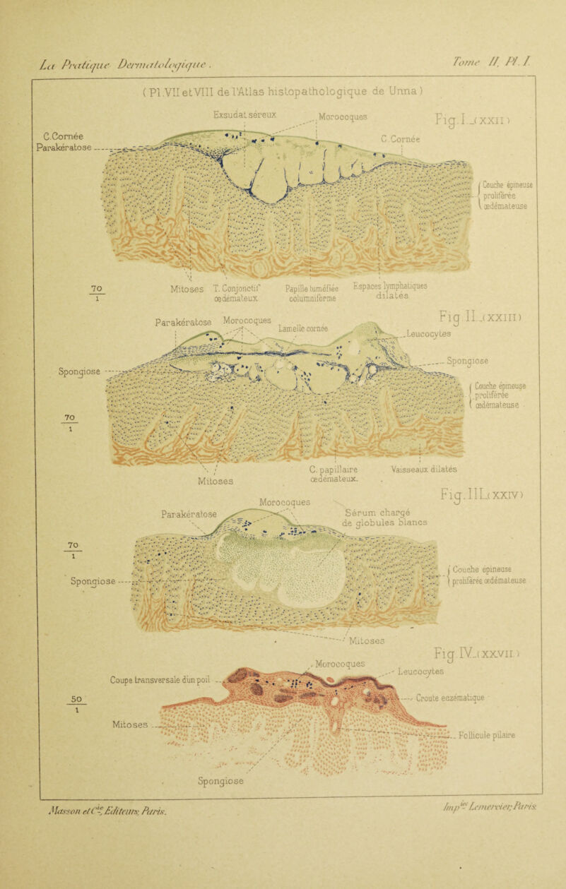 La Pratiqua Deniui/o/oqique. Tome // PI. / Masson etC?£i/iteiwr, Pt/ri.v. Imp Lememep Paris. C.Cornée -'arakératose ( Pl.VIIetVIII de l’Atlas histopathologique de Unna) Exsudai séreux Monocoques ***** ^ C.Cornée Fig-!--■ (XXII > . ÿ'V'- 'CÎ { Couche epmeuse ...........-^v yr::-..: PPppP■' proliférée ■<■■ ■■' '.pr-?.y I œdémateuse Mitoses T. Conjonctif Papille tuméfiée Espaces lymphatiques rnlnmnifnpmp ClllâtôS Sponcjiose oedémateux columniforme Parakératose Moroccques Lamelle cornee Fig. II,( xxiii) J|V-_.^__Leucocytes __Spongiose .... •vc.'zv.-cw\ y•û'rh -1 :f.;V.Jp\ ( Couche epmeuse -If- f-vf-rr - ; j'- : : :f f; 1-y .proliférée ■ \ ;:: A- ( œdémateuse \ i / Mitoses •P,- œdémateux. Parakératose Moroeoques C. papillaire Vaisseaux dilatés Fig. I IL xxLV) Sérum chargé de globules blancs Sponciose — :;-fy y ~ -7 >' pi yfff; ' ■ -pu f -j.C , i Couche epmeuse • y.; • j proliférée œdémateuse •: - ■'.. . 'AP Coups transversale dimpoil Mitoses -... A--:: v: i». / Mitoses , Moroeoques Fig. IY-( XXVII). Leucocytes ■- Croûte eezématique - Follicule pilaire Spongiose