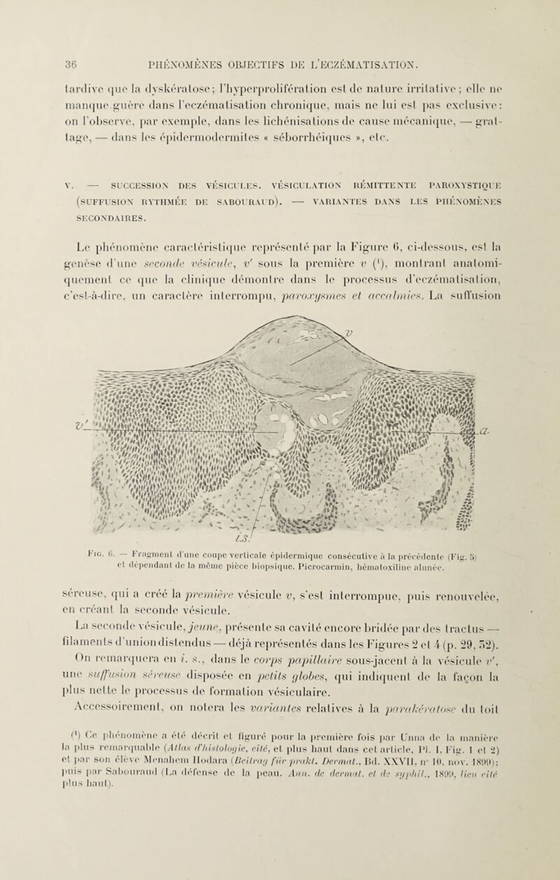 tardive que la dyskératose; l’hyperprolifération est de nature irritative; elle ne manque.guère dans l'eczématisation chronique, mais ne lui est pas exclusive: on l’observe, par exemple, dans les lichénisations de cause mécanique, — grat¬ tage,— dans les épidermodermiles « séborrhéiques », etc. V. — SUCCESSION DES VÉSICULES. VÉSICULATION RÉMITTENTE PAROXYSTIQUE (SUFFUSION RYTHMÉE DE SABOURAUD). - VARIANTES DANS LES PHÉNOMÈNES SECONDAIRES. Le phénomène caractéristique représenté par la Figure 0, ci-dessous, est la genèse d'une seconde vésicule, v' sons la première v (*), montrant anatomi¬ quement ce que la clinique démontre dans le processus d’eczématisation, c’est-à-dire, un caractère interrompu, paroxysmes et accalmies. La suffusion LS J m $ p- Fio. G. — Fragment d'une coupe verticale épidermique consécutive à la précédente (Fig. 5) et dépendant de la môme pièce biopsique. Picrocarmin, hématoxiline alunée. séreuse, (jui a créé la première vésicule v, s’est interrompue, puis renouvelée, en créant la seconde vésicule. La seconde vésicule, jeune, présente sa cavité encore bridée par des tractus — filaments d union distendus — déjà représentés dans les Figures 2 et 4 (p. 29. 52). On remarquera eu i. s., dans le corps papillaire sous-jacent à la vésicule v', une suffusion sereuse disposée en petits globes, qui indiquent de la façon la plus nette le processus de formation vésiculaire. Accessoirement, on notera les variantes relatives à la paon kératose du loi! C) f-c phénomène a été décrit el figuré pour la première fois par (Jnna de la manière la plus remarquable (Allas ({'histologie, cité, et plus haut dans cel article. 1*1. I, Fig. 1 et k2) e! par son élève Menahem Ilodara (Beitrag fiir prakt. Devinât., Bd. XXVII, n 10. nov. 1809); puis par Sabouraud (La défense de la peau. Ann. cle dermat. et de syphil., 1890, lieu cité plus haut).