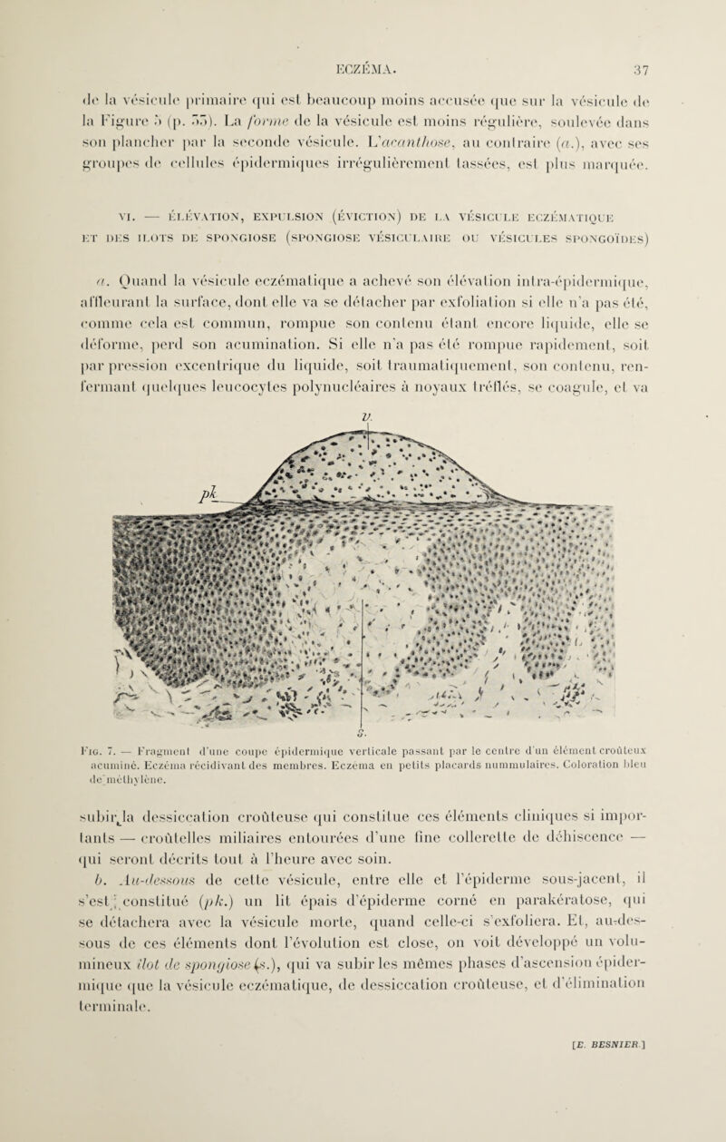 de la vésicule primaire qui est beaucoup moins accusée que sur la vésicule de la Figure b (p. ôo). La forme de la vésicule est moins régulière, soulevée dans son plancher par la seconde vésicule. L'acanthose, au contraire (a.), avec ses groupes de cellules épidermiques irrégulièrement tassées, est plus marquée. VI. - ÉLÉVATION, EXPULSION (ÉVICTION) DE LA VÉSICULE ECZÉMATIQUE ET DES ILOTS DE SPONGIOSE (SPONGIOSE VÉSICULAIRE OU VÉSICULES SPONGOÏDEs) a. Quand la vésicule eczématique a achevé son élévation intra-épidermique, affleurant la surface, dont elle va se détacher par exfoliai iou si elle n’a pas été, comme cela est commun, rompue son contenu étant encore liquide, elle se déforme, perd son acumination. Si elle n’a pas été rompue rapidement, soit par pression excentrique du liquide, soit traumatiquement, son contenu, ren¬ fermant quelques leucocytes polynucléaires à noyaux trèfles, se coagule, et va v. Ô u • Fjg. 7. — Fragment d’une coupe épidermique verticale passant par le centre d’un élément croûteux acuminé. Eczéma récidivant des membres. Eczema en petits placards nummulaires. Coloration bleu de'mélhylène. subirja dessiccation croûteuse qui constitue ces éléments cliniques si impor¬ tants — croùtelles miliaires entourées d’une fine collerette de déhiscence — qui seront décrits tout à l’heure avec soin. b. Au-dessous de cette vésicule, entre elle et l’épiderme sous-jacent, il s’est' constitué (pk.) un lit épais d’épiderme corné en parakératose, qui se détachera avec la vésicule morte, quand celle-ci s’exfoliera. Et, aiudes- sous de ces éléments dont l’évolution est close, on voit développé un volu¬ mineux îlot de spongiose (.s.), qui va subir les mêmes phases d’ascension épider¬ mique que la vésicule eczématique, de dessiccation croûteuse, et d’élimination terminale.