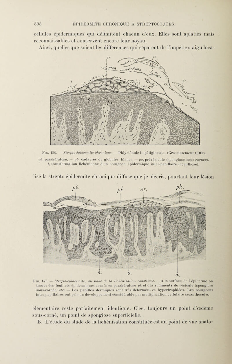 cellules épidermiques qui délimitent chacun d’eux. Elles sont aplaties mais reconnaissables et conservent encore leur noyau. Ainsi, quelles que soient les différences qui séparent de l’impétigo aigu loca- S ' (a c->>- v Î'^WÎÉI •i SAStpS rasas*»* - v u +mb ♦ Fig. 136. — Slreplo-épidermite chronique. — Phlycténule impéligineuse. (Grossissement 1/iOO). pk, parakératose. — gb, cadavres de globules blancs.—pv, prévésicule (spongiose sous-cornée). /, transformation lichénienne d’un bourgeon épidermique inter-papillaire (acantbose). lisé la strepto-épidermile chronique diffuse que je décris, pourtant leur lésion Fig. 137. — Slrepto-epidermüe, au stade de la lichénisation constituée. — A la surface de l’épiderme on trouve des feuillets épidermiques cornés en parakératose pk et des rudiments de vésicule (spongiose sous-cornée) sir. — Les papilles dermiques sonL très déformées et hypertrophiées. Les bourgeons inter-papillaires ont pris un développement considérable par multiplication cellulaire (acantbose) a. élémentaire reste parfaitement identique. C’est toujours un point d’œdème sous-corné, un point de spongiose superficielle. B. L’étude du stade de la lichénisation constituée est au point de vue anato-