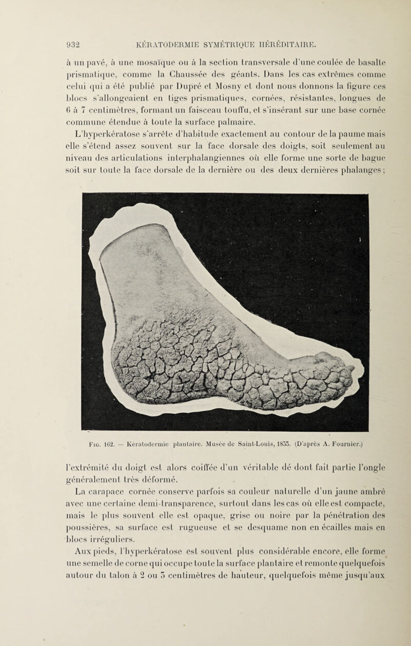 à un pavé, à une mosaïque ou à la section transversale d’une coulée de basalte prismatique, comme la Chaussée des géants. Dans les cas extrêmes comme celui qui a été publié par Dupré et Mosny et dont nous donnons la figure ces blocs s’allongeaient en liges prismatiques, cornées, résistantes, longues de 6 à 7 centimètres, formant un faisceau touffu, et s’insérant sur une base cornée commune étendue à toute la surface palmaire. L’hyperkératose s’arrête d’habitude exactement au contour de la paume mais elle s’étend assez souvent sur la face dorsale des doigts, soit seulement au niveau des articulations interphalangiennes oii elle forme une sorte de bague soit sur toute la face dorsale de la dernière ou des deux dernières phalanges ; Fig. 1G2. — Kératodermie plantaire. Musée de Saint-Louis, 1835. (D'après A. Fournier.) l’extrémité du doigt est alors coiffée d’un véritable dé dont fait partie l’ongle généralement très déformé. La carapace cornée conserve parfois sa couleur naturelle d’un jaune ambré avec une certaine demi-transparence, surtout dans les cas où elle est compacte, mais le plus souvent elle est opaque, grise ou noire par la pénétration des poussières, sa surface est rugueuse et se desquame non en écailles mais en blocs irréguliers. Aux pieds, l’hyperkératose est souvent plus considérable encore, elle forme une semelle de corne qui occupe toute la surface plantaire et remonte quelquefois autour du talon à 2 ou 5 centimètres de hauteur, quelquefois même jusqu’aux