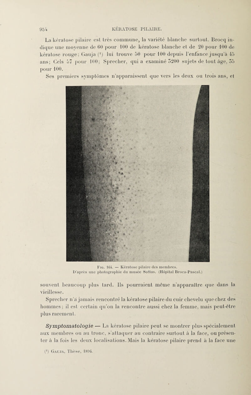 La kératose pilaire est très commune, la variété blanche surtout. Brocq in¬ dique une moyenne de 60 pour 100 de kératose blanche et de 120 pour 100 de kératose rouge; Gauja (*) lui trouve 50 pour 100 depuis l’enfance jusqu’à 45 ans; Gels 57 pour 100; Sprecher, quia examiné 5200 sujets de tout âge, 55 pour 100. Ses premiers symptômes n’apparaissent que vers les deux ou trois ans, et Fig. 161. — Kératose pilaire des membres. D’après une photographie du musée Sottas. (Hôpital Broca-Pascal.) souvent beaucoup plus tard. Ils pourraient même n'apparaître (pie dans la vieillesse. Sprecher n’a jamais rencontré la kératose pilaire du cuir chevelu que chez des hommes ; il est certain qu’on la rencontre aussi chez la femme, mais peut-être plus rarement. Symptomatologie — La kératose pilaire peut se montrer plus spécialement aux membres ou au tronc, s'attaquer au contraire surtout à la face, ou présen¬ ter à la fois les deux localisations. Mais la kératose pilaire prend à la face une (•) Gauja, Thèse, 1894.