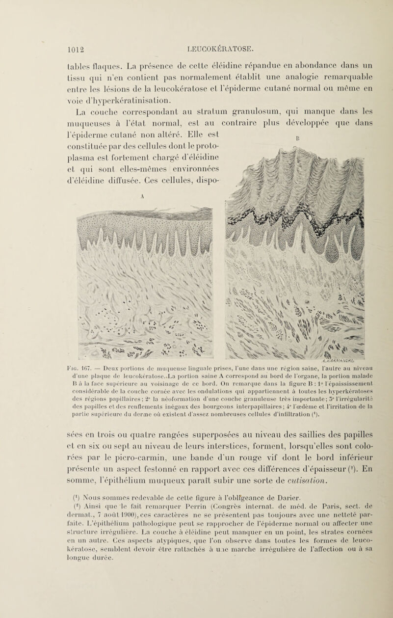 tables flaques. La présence de cette éléidine répandue en abondance dans un tissu qui n’en contient pas normalement établit une analogie remarquable entre les lésions de la leucokératose et l’épiderme cutané normal ou même en Fig. 167. — Deux perlions de muqueuse linguale prises, l'une dans une région saine, l’autre au niveau d’une plaque de leucokératose..La portion saine A correspond au bord de l’organe, la portion malade B à la lace supérieure au voisinage de ce bord. On remarque dans la figure B : 1° l épaississemcnt considérable de la couche cornée avec les ondulations qui appartiennent à toutes les hyperkératoses des régions papillaires ; 2° la néoformation d’une couche granuleuse très importante ; 3“ l’irrégularité des papilles et des renflements inégaux des bourgeons interpapillaires; l l’œdème et l’irritation de la partie supérieure du derme où existent d’assez nombreuses cellules d’infiltration (*). voie d’hyperkératinisation. La couche correspondant au stratum granulosum, qui manque dans les muqueuses à l’état normal, est au contraire plus développée que dans l’épiderme cutané non altéré. Elle est constituée par des cellules dont le proto¬ plasma est fortement chargé d'éléidine et qui sont elles-mêmes environnées d’éléidine diffusée. Ces cellules, dispo¬ sées on trois ou quatre rangées superposées au niveau des saillies des papilles et en six ou sept au niveau de leurs interstices, forment, lorsqu’elles sont colo¬ rées par le picro-carmin, une bande d’un rouge vif dont le bord inférieur présente un aspect festonné en rapport avec ces différences d’épaisseur {-). En somme, l’épithélium muqueux paraît subir une sorte de cutisation. C) Nous sommes redevable de celle figure à l’obirgcance de Darier. (â) Ainsi que le fait remarquer Perrin (Congrès internat, de méd. de Paris, seot. de dermat., 7 août 1900), ces caractères ne se présentent pas toujours avec une netteté par¬ faite. L’épithélium pathologique peut se rapprocher de l’épiderme normal ou affecter une structure irrégulière. La couche à éléidine peut manquer en un point, les strates cornées en un autre. Ces aspects atypiques, que l’on observe dans toutes les formes de leuco- kôralosc, semblent devoir être rattachés à u.ic marche irrégulière de l’affection ou à sa longue durée.