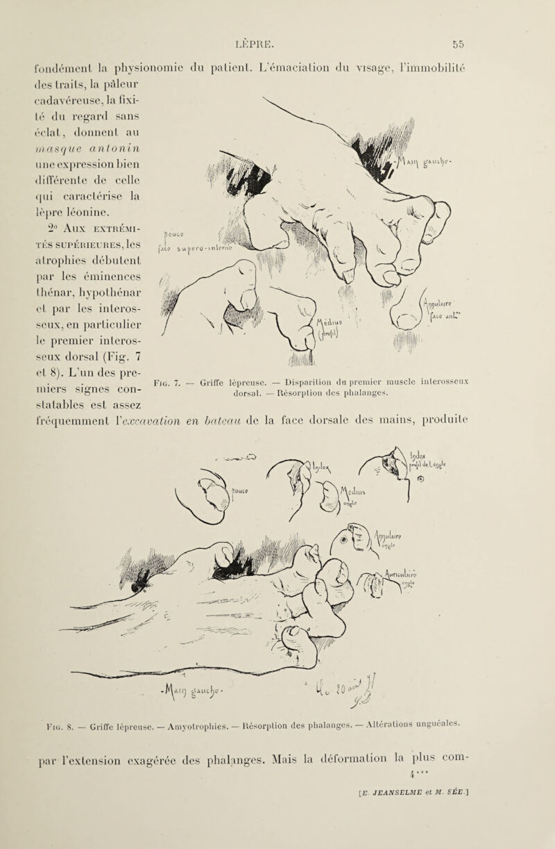 fondement la physionomie du patient. L’émaciation du visage, l’immobilité des traits, la pâleur cadavéreuse, la fixi- lé du regard sans éclat, donnent au masque antonin une expression bien différente de celle qui caractérise la lèpre léonine. 2° AUX EXTRÉMI¬ TÉS SUPÉRIEURES, les atrophies débutent par les éminences thénar, hypothénar et par les interos¬ seux, en particulier le premier interos¬ seux dorsal (Fig. 7 et 8). L’un des pre¬ miers signes con¬ Fig. 7. — Griffe lépreuse. — Disparition du premier muscle inlerosscux dorsal. — Résorption des phalanges. statables est assez fréquemment Vexcavation en bateau de la face dorsale des mains, produite ' n Allj g’AWC^C Fig. 8. — Griffe lépreuse. — Amyolrophies, — Résorption des phalanges. — Altérations unguéales. par l’extension exagérée des phalanges. Mais la déformation la plus com -i * * *