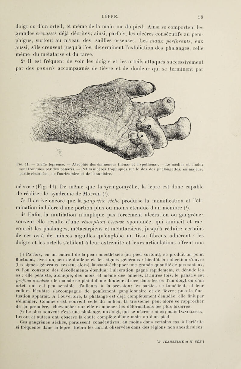 doigt ou d’un orteil, et même de la main ou du pied. Ainsi se comportent les grandes crevasses déjà décrites; ainsi, parfois, les ulcères consécutifs au pem- phigus, surtout au niveau des saillies osseuses. Les maux perforants, eux aussi, s’ils creusent jusqu’à l’os, déterminent l’exfoliation des phalanges, celle même du métatarse et du tarse. 2° Il est fréquent de voir les doigts et les orteils attaqués successivement par des panaris accompagnés de fièvre et de douleur qui se terminent par Fig. 11. — Griffe lépreuse. — Atrophie des éminences thénar et hvpothénar. — Le médius et l’index sont tronqués par des panaris. — Petits ulcères trophiques sur le dos des phalangettes, en majeure partie résorbées, de l’auriculaire et de l’annulaire. nécrose (Fig. 11). De même que la syringomyélie, la lèpre est donc capable de réaliser le syndrome de Morvan ('). 5° Il ar rive encore que la gangrène sèche produise la momification et l’éli¬ mination indolore d'une portion plus ou moins étendue d’un membre (2). 4° Enfin, la mutilation n’implique pas forcément ulcération ou gangrène; souvent elle résulte d’une résorption osseuse spontanée, qui amincit et rac¬ courcit les phalanges, métacarpiens et métatarsiens, jusqu’à réduire certains de ces os à de minces aiguilles qu’englobe un tissu fibreux adhérent : les doigts et les orteils s’effilent à leur extrémité et leurs articulations offrent une (’) Parfois, en un endroit de la peau anesthésiée (au pied surtout), se produit un point fluctuant, avec un peu de douleur et des signes généraux : bientôt la collection s’ouvre (les signes généraux cessent alors), laissant échapper une grande quantité de pussanicux, et l’on constate des décollements étendus ; l’ulcération gagne rapidement, et dénude les os ; elle persiste, atonique, des mois et même des années. D’autres fois, le panaris est profond d'emblée : le malade se plaint d’une douleur atroce dans les os d’un doigt ou d’un orteil qui est peu sensible d’ailleurs à la pression; les parties se tuméfient, et leur enflure bleuâtre s’accompagne de gonflement ganglionnaire et de fièvre; puis la fluc¬ tuation apparaît. A l’ouverture, la phalange est déjà complètement dénudée, elle finit par s’éliminer. Comme c’est souvent celle du milieu, la troisième peut alors se rapprocher de la première, chevaucher sur elle et amener les déformations les plus bizarres (*) Le plus souvent c’est une phalange, un doigt, qui se nécrose ainsi; mais Danielssen, Leloir et autres ont observé la chute complète d’une main ou d’un pied. Ces gangrènes sèches, paraissent consécutives, au moins dans certains cas, à l’artérite si fréquente dans la lèpre Ilébra les aurait observées dans des régions non anesthésiées.