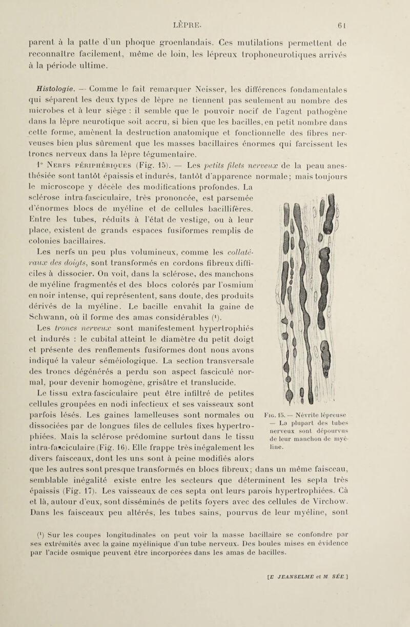 parent à la patte d’un phoque groenlandais. Ces mutilations permettent de reconnaître facilement, même de loin, les lépreux trophoneurotiques arrivés à la période ultime. Histologie. — Comme le fait remarquer Neisser, les différences fondamentales qui séparent les deux types de lèpre ne tiennent pas seulement au nombre des microbes et à leur siège : il semble que le pouvoir nocif de l’agent pathogène dans la lèpre neurotique soit accru, si bien que les bacilles, en petit nombre dans cette forme, amènent la destruction anatomique et fonctionnelle des libres ner¬ veuses bien plus sûrement que les masses bacillaires énormes qui farcissent les troncs nerveux dans la lèpre tégumentaire. 1° Nerfs périphériques (Fig. 15). — Les petits filets nerveux de la peau anes¬ thésiée sont tantôt épaissis et indurés, tantôt d'apparence normale; mais toujours le microscope y décèle des modifications profondes. La sclérose intra-fasciculaire, très prononcée, est parsemée d’énormes blocs de myéline et de cellules bacillifères. Entre les tubes, réduits à l’état de vestige, ou à leur place, existent de grands espaces fusiformes remplis de colonies bacillaires. Les nerfs un peu plus volumineux, comme les collaté¬ raux des doigts, sont transformés en cordons fibreux diffi¬ ciles à dissocier. On voit, dans la sclérose, des manchons de myéline fragmentés et des blocs colorés par l’osmium en noir intense, qui représentent, sans doute, des produits dérivés de la myéline. Le bacille envahit la gaine de Schwann, où il forme des amas considérables (4). Les troncs nerveux sont manifestement hypertrophiés et indurés : le cubital atteint le diamètre du petit doigt et présente des renflements fusiformes dont nous avons indiqué la valeur séméiologique. La section transversale des troncs dégénérés a perdu son aspect fasciculé nor¬ mal, pour devenir homogène, grisâtre et translucide. Le tissu extra-fasciculaire peut être infiltré de petites cellules groupées en nodi infectieux et ses vaisseaux sont parfois lésés. Les gaines lamelleuses sont normales ou dissociées par de longues files de cellules fixes hypertro¬ phiées. Mais la sclérose prédomine surtout dans le tissu intra-fasciculaire (Fig. 16). Elle frappe très inégalement les divers faisceaux, dont les uns sont à peine modifiés alors que les autres sont presque transformés en blocs fibreux; dans un même faisceau, semblable inégalité existe entre les secteurs que déterminent les septa très épaissis (Fig. 17). Les vaisseaux de ces septa ont leurs parois hypertrophiées. Cà et là, autour d’eux, sont disséminés de petits foyers avec des cellules de Virchow. Dans les faisceaux peu altérés, les tubes sains, pourvus de leur myéline, sont (*) Sur les coupes longitudinales on peut voir la masse bacillaire se confondre par ses extrémités avec la gaine myélinique d’un tube nerveux. Des boules mises en évidence par l’acide osmique peuvent être incorporées dans les amas de bacilles. Fig. 15. — Névrite lépreuse — La plupart des tubes nerveux sont dépourvus de leur manchon de myé¬ line.