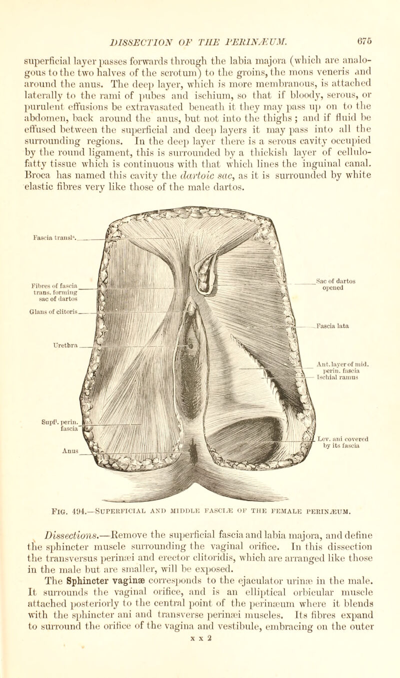 superficial layer passes forwards through the labia majora (which are analo¬ gous lothe two halves of the scrotum) to the groins, the mons veneris and around the anus. The deep layer, which is more membranous, is attached laterally to the rami of pubes and ischium, so that if bloody, serous, or purulent effusions be extravasated beneath it they may pass up on to the abdomen, back around the anus, but not into the thighs ; and if fluid be effused between the superficial and deep layers it may pass into all the surrounding regions. In the deep layer there is a serous cavity occupied by the round ligament, this is surrounded by a thickish layer of cellulo- fatty tissue which is continuous with that which lines the inguinal canal. Broca has named this cavity the dartoic sac, as it is surrounded by white Fascia trail si. Glaus of clitoris -.Fascia lata Urethra Ant. layer of mid. perim fascia Ischial ramus Lev. uni covered by its fascia Fibres of fascia trans. forming sac of dartos Sac of dartos opened Supf1. perin. fascia Anus Fig. 494.—Superficial and middle fasciae of the female perineum. Dissections.—Remove the superficial fascia and labia majora, and define the sphincter muscle surrounding the vaginal orifice. In this dissection the transversus perinsei and erector clitoridis, which are arranged like those in the male but are smaller, will be exposed. The Sphincter vaginae corresponds to the ejaculator urime in the male. It surrounds the vaginal orifice, and is an elliptical orbicular muscle attached posteriorly to the central point of the perinioum where it blends with the sphincter ani and transverse perinaei muscles. Its fibres expand to surround the orifice of the vagina and vestibule, embracing on the outer x x 2