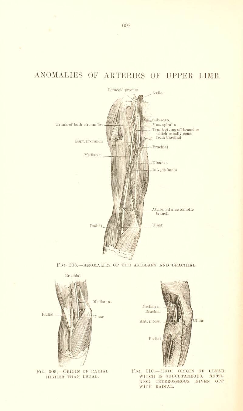 ANOMALIES OF ARTERIES OF UPPER LIMB. Coracoid process Trunk of both circumflex Supr, profunda Median n. Radial Axils'. Sub-scap. Mus.-spiral n. Trunk giving off brandies which usually come from brachial Brachial Ulnar n. Inf. profunda Abnormal anastomotic branch Ulnar Fig. 508.—Anomalies of the axillary and braciiial. Fig. 510.—High origin of ulnar WHICH IS SUBCUTANEOUS. ANTE¬ RIOR INTEROSSEOUS given off WITH RADIAL.