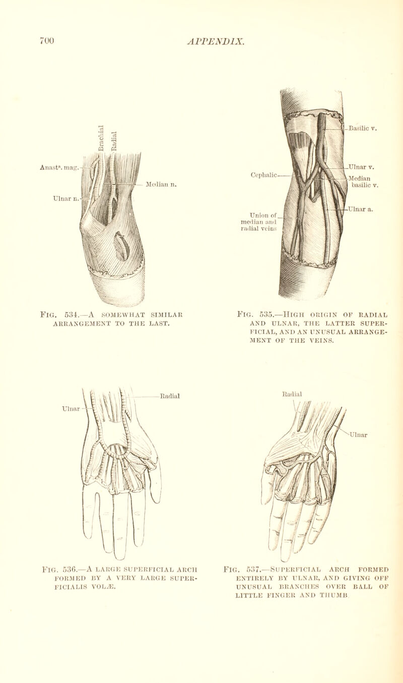 Fig. 535.—High origin of radial AND ULNAR, THE LATTER SUPER¬ FICIAL, AND AN UNUSUAL ARRANGE¬ MENT OF THE VEINS. Fig. 536.—A large superficial arch FORMED BY A VERY LARGE SUPER- FICIALIS VOLjE. Railiiil Fig. 537.—Superficial arch formed ENTIRELY BY ULNAR, AND GIVING OFF UNUSUAL BRANCHES OVER BALL OF LITTLE FINGER AND THUMB