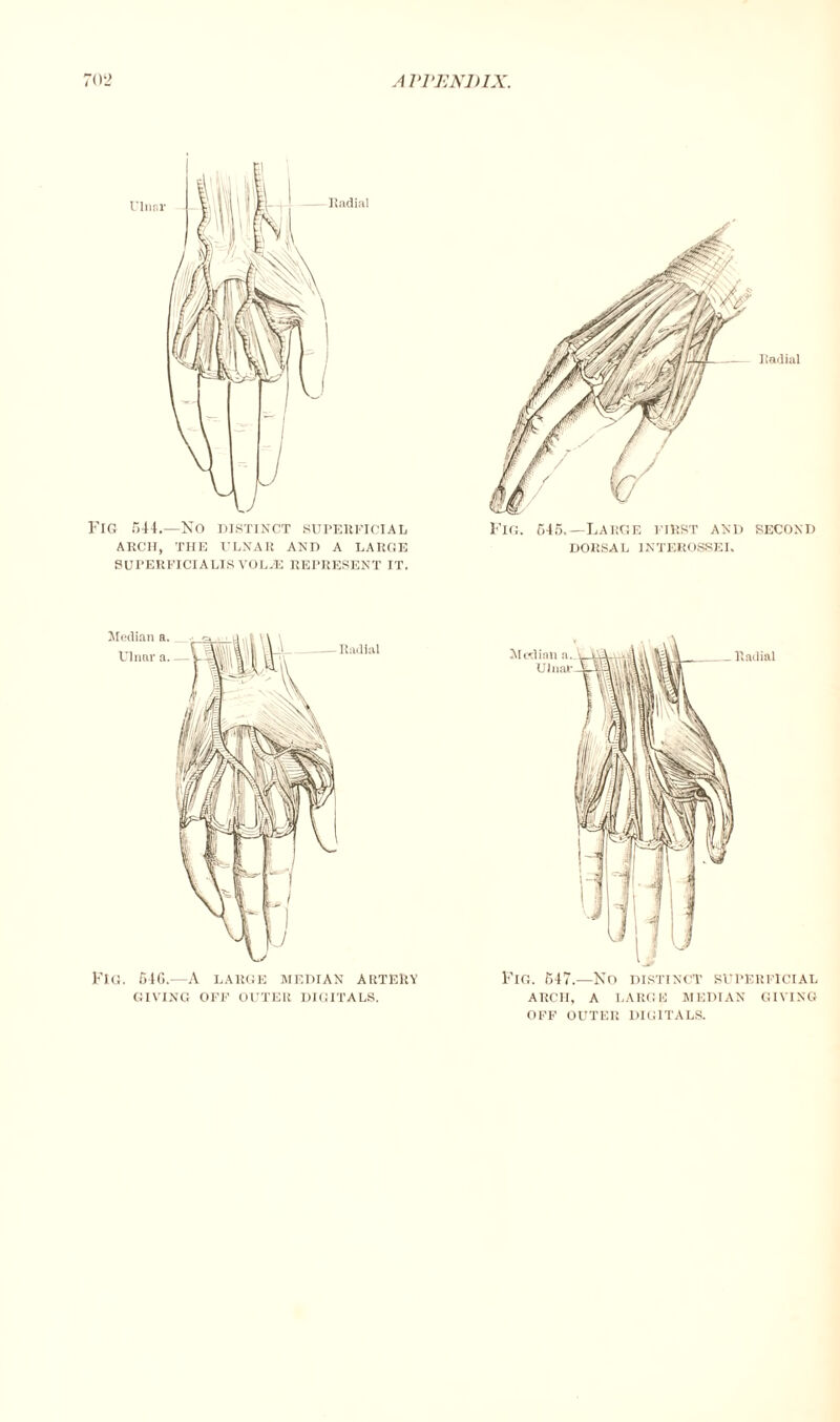 Fig 544.—No distinct superficial ARCH, THE ULNAR AND A LARGE SUPERFICIALIS VOLHC REPRESENT IT. DORSAL 1NTER0SSEI. Fig. 546.—A large median artery GIVING OFF OUTER DIGITALS. Fig. 547.—No distinct superficial ARCH, A LARGE MEDIAN GIVING OFF OUTER DIGITALS.