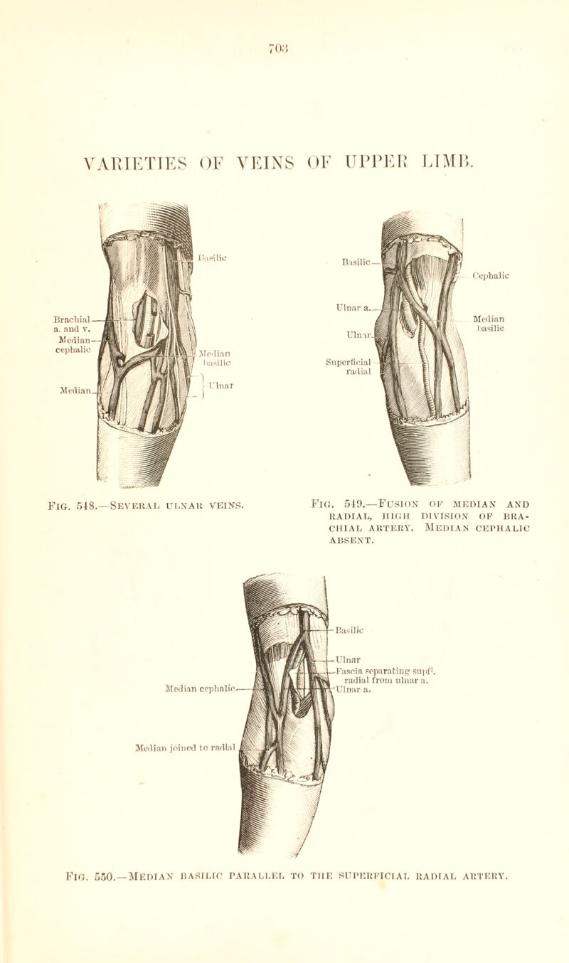 70-} VARIETIES OF VEINS OF UPPER LI M1 y y. Hirilio Basilic Brachial a. aud v. cephalic Median basilic ) - Ulnar Ulnar Ulnar Superficial radial Cephalic Median basilic Fig. 548 —Several ulnar veins, Fig. 549.—Fusion op median and RADIAL, HIGH DIVISION OP BRA¬ CHIAL artery. Median cephalic absent. Fig. 550.—Median basilic parallel to tup. superficial radial artery.